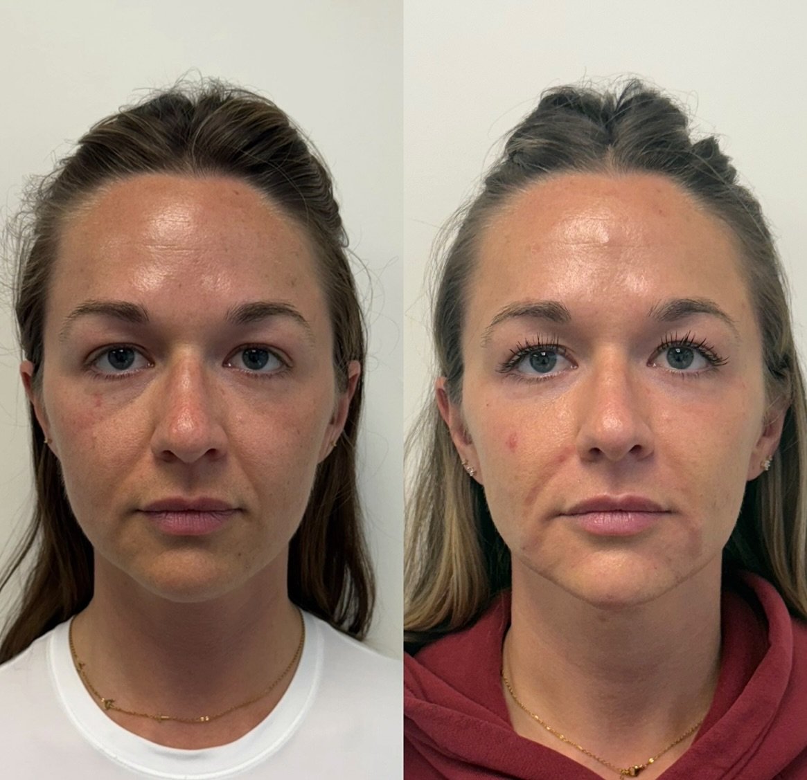 Filler looks better over time and when it&rsquo;s had the chance to take on water. It also looks better when you go low and slow placing a little in multiple places!

This patient came in April where we did one syringe in her midface and one syringe 