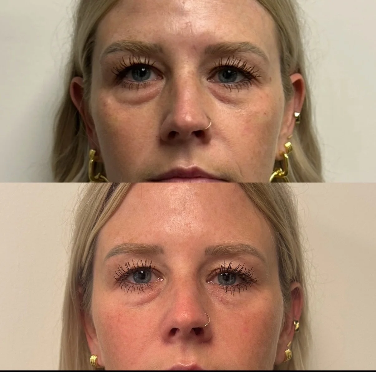 This is before and 3 weeks after just one PRF EZ Gel treatment🤯 Here are the most important things you need to know about PRF EZ Gel:

1️⃣ It is using your own stem cells to grow collagen and elasticity. It helps tighten the tissue causing crepiness