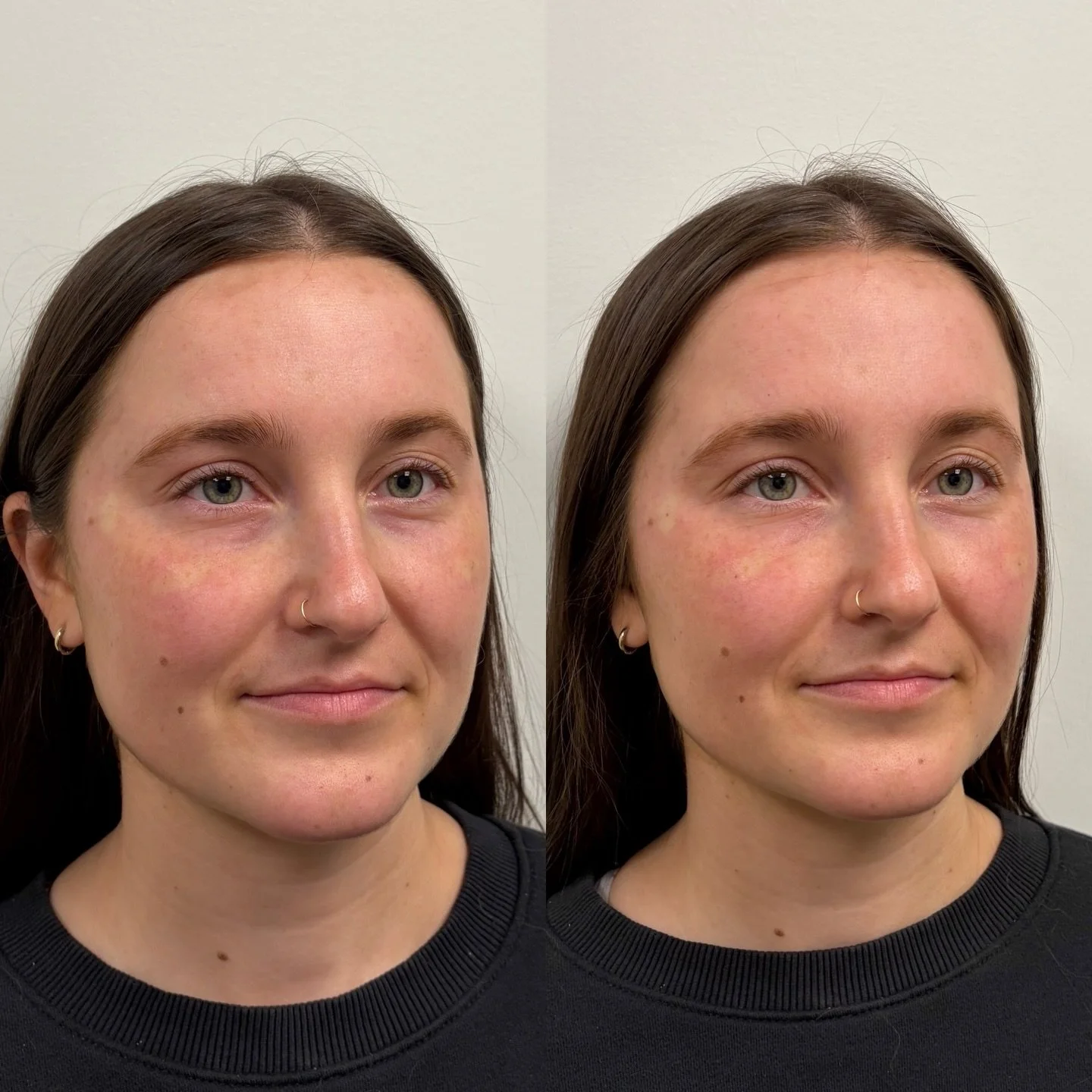 A perfect candidate for undereye filler must have:

- good temple volume
- midcheek support
- thick undereye skin with adequate elasticity
- very minimal undereye fat pad, none preferably for the best results 

If even one criteria is missing, it mus