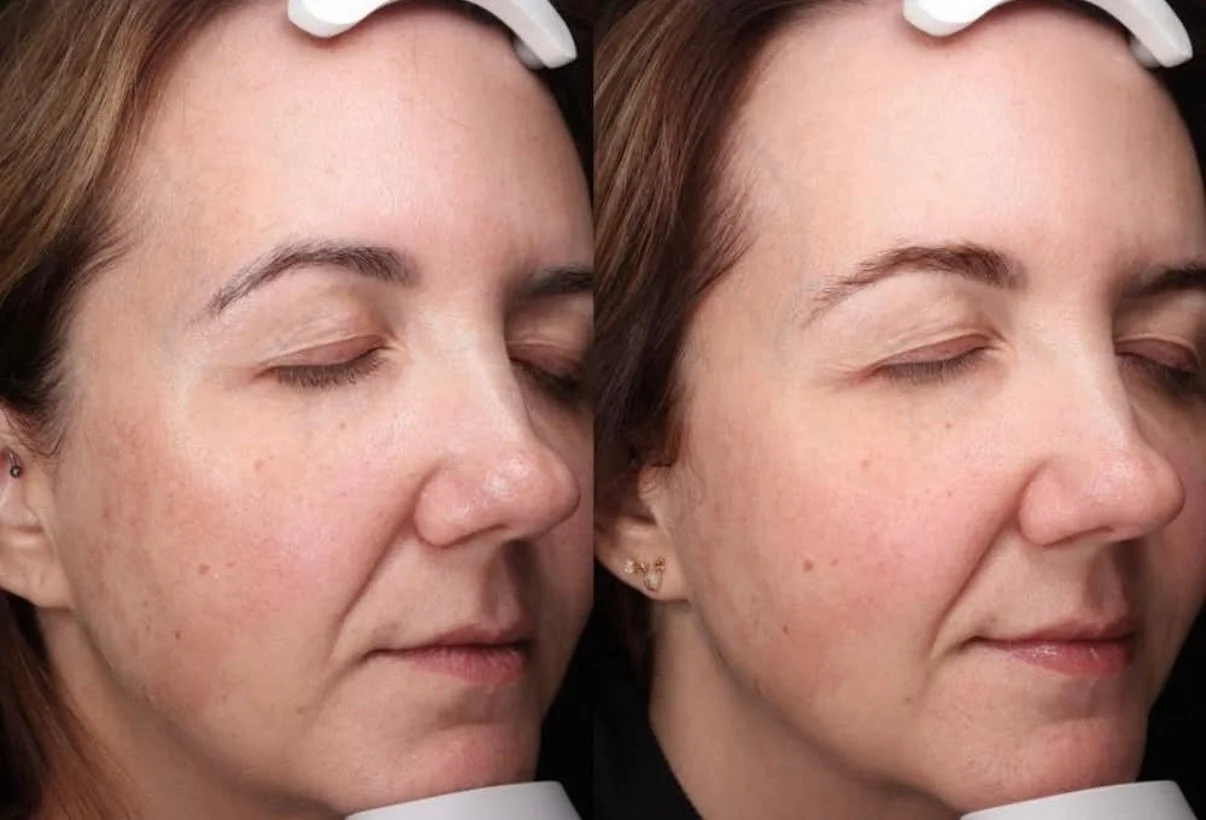 This before &amp; after is from our MOXI laser, a powerful treatment that targets pigment, improves tone, and boosts overall skin quality.

If you have melasma, this OR our VI Peel is the perfect treatment for you. As always, a consultation is highly