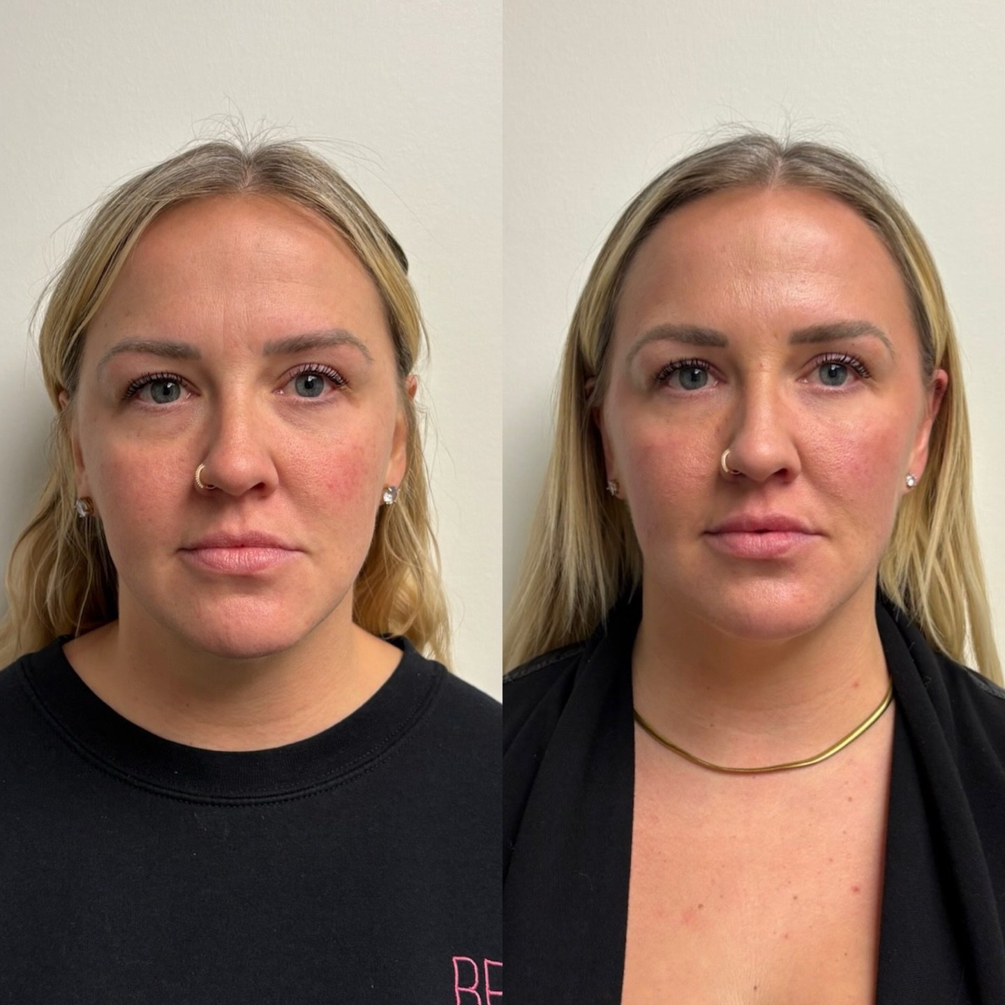 This bride-to-be received a full face assessment where we decided to treat her entire face. Do I even need to finish this caption? *mic drop*