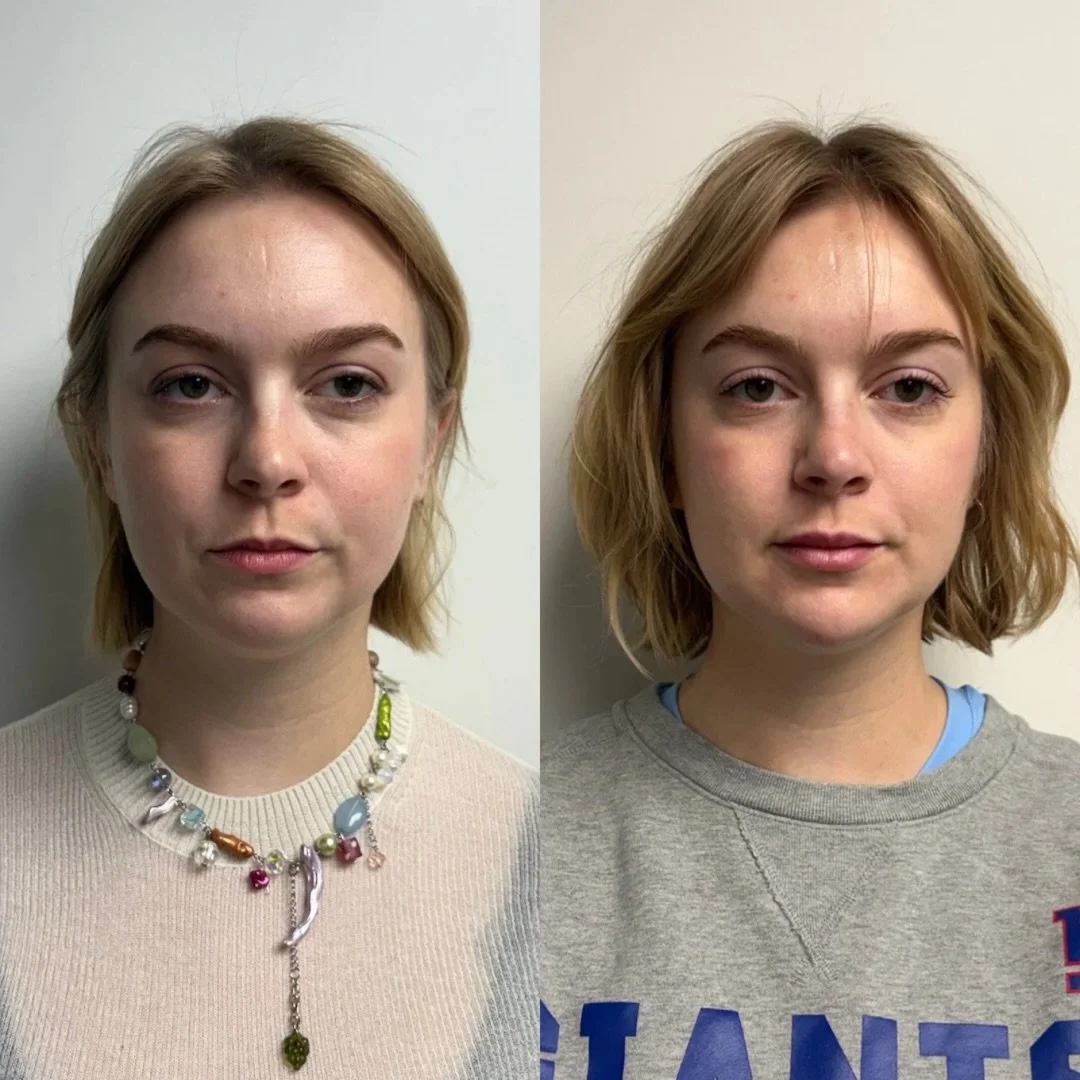 Swipe ➡️ Before, immediately after, and 2 weeks post-treatment

This is why we always say don&rsquo;t love it or hate it for 14 full days!