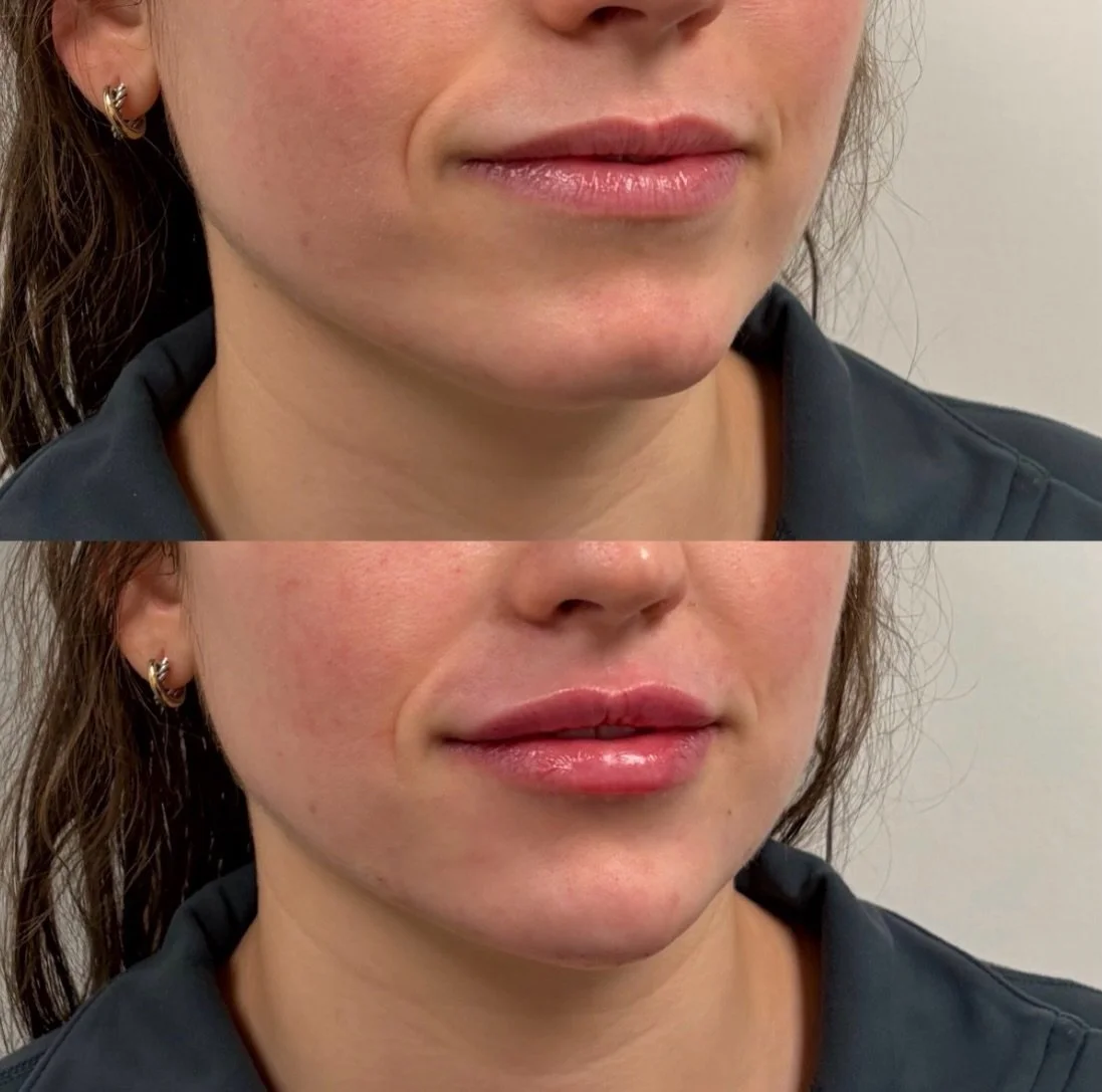 This client came in wanting lip filler. After assessing her face, Lily came up with a treatment plan that consisted of filler in her temples, midface, smile lines, aperture (triangle area next to her nose), chin, chin shadow, and lips. She couldn&rsq