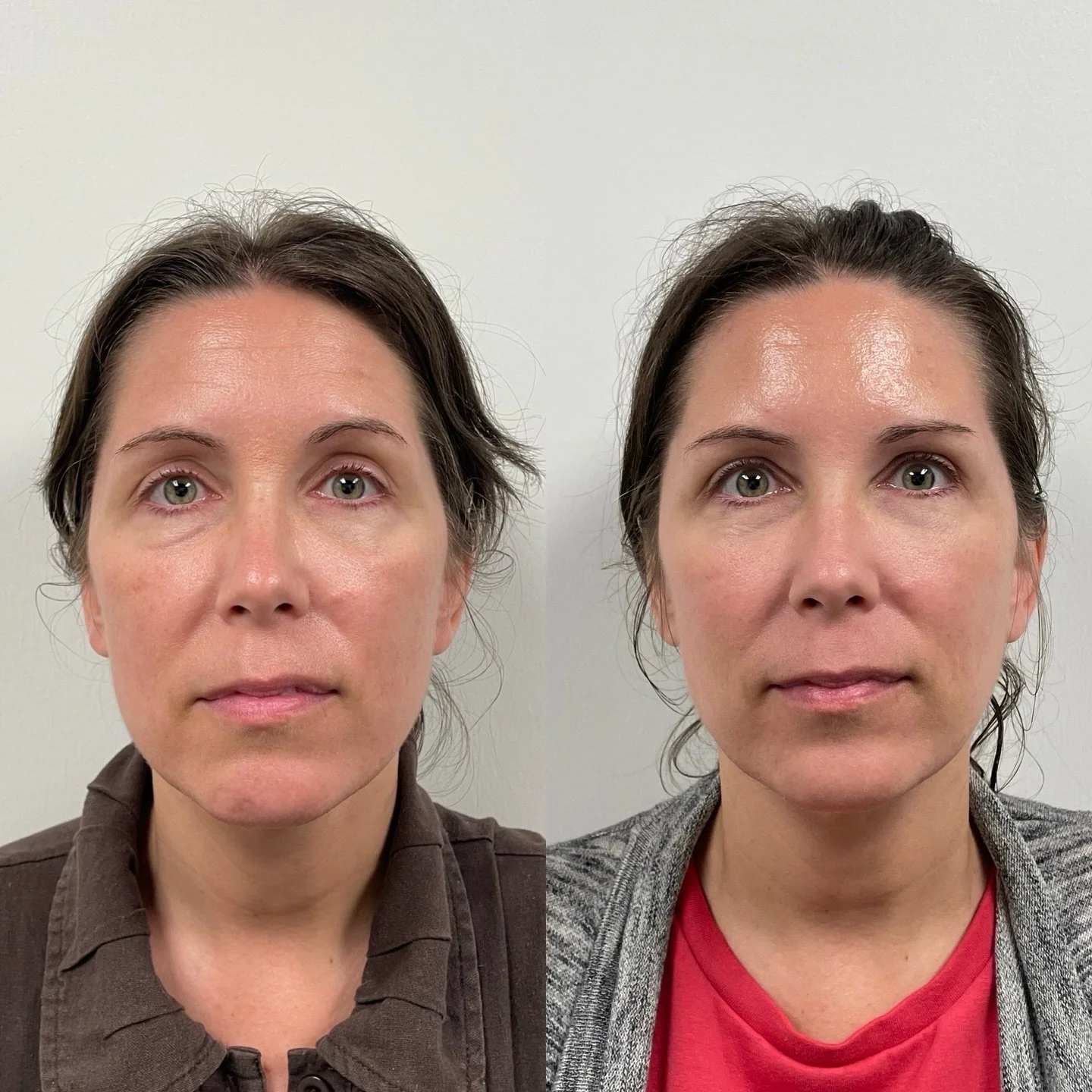 You start to lose 1% of collagen every year after the age of 25 and it rapidly declines at age 35📉

Sculptra is a biostimulator that helps you restore your collagen and elasticity. You&rsquo;ll maintain that for AT LEAST 25 MONTHS! It&rsquo;s not so