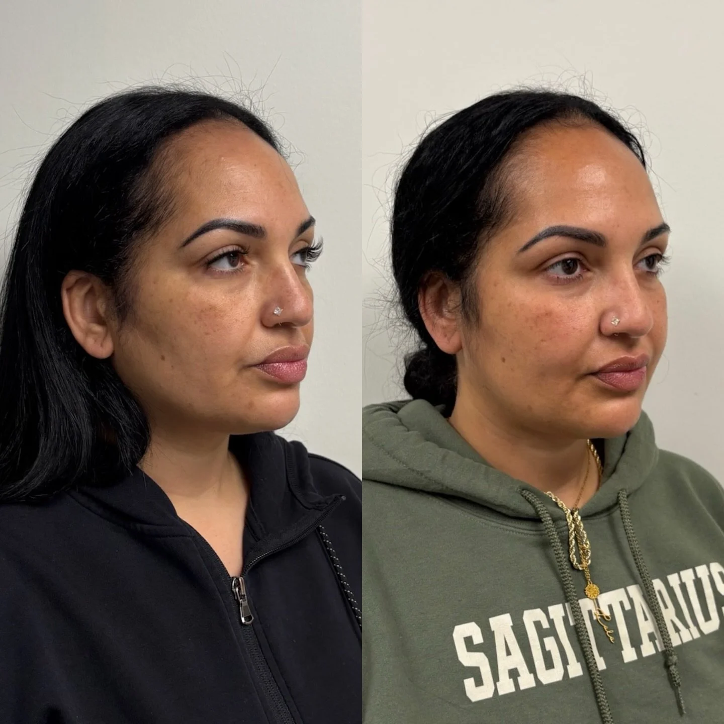 Trust the process⏳

This full face treatment included mid cheek, nasolabial folds, aperture, chin &amp; shadow to restore structure and balance.

Swipe to see before &rarr; immediately after &rarr; 2 weeks after

And this is your reminder: don&rsquo;