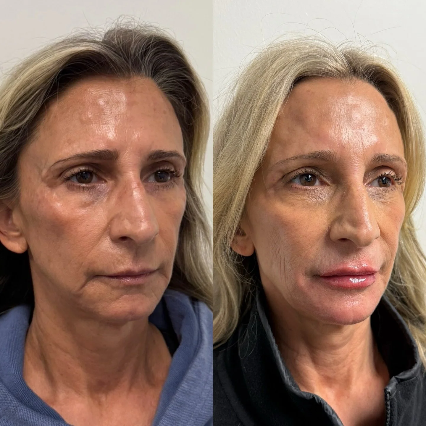 Aging doesn&rsquo;t just create wrinkles, it also causes the face to shift forward and downward, which is what leads to one of the most common concerns we hear about: jowls.

The best results come from treating this in a multifactorial way:

✨ Sculpt