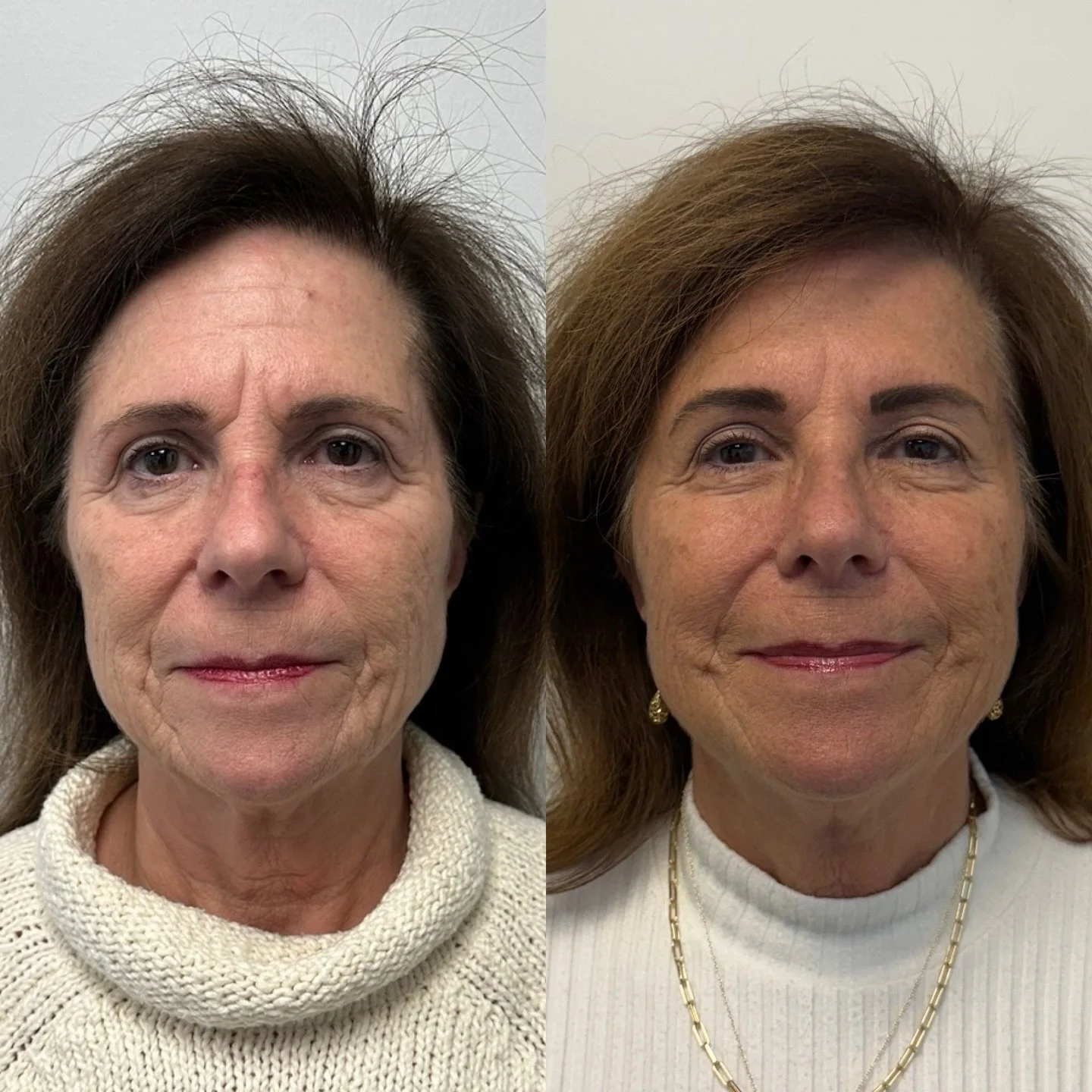 Not everyone wants surgery and not everyone has to. 

I&rsquo;m always honest with my patients: if you want significant lifting and tightening, surgery will give the most dramatic result. But if surgery isn&rsquo;t something you want, we can still cr