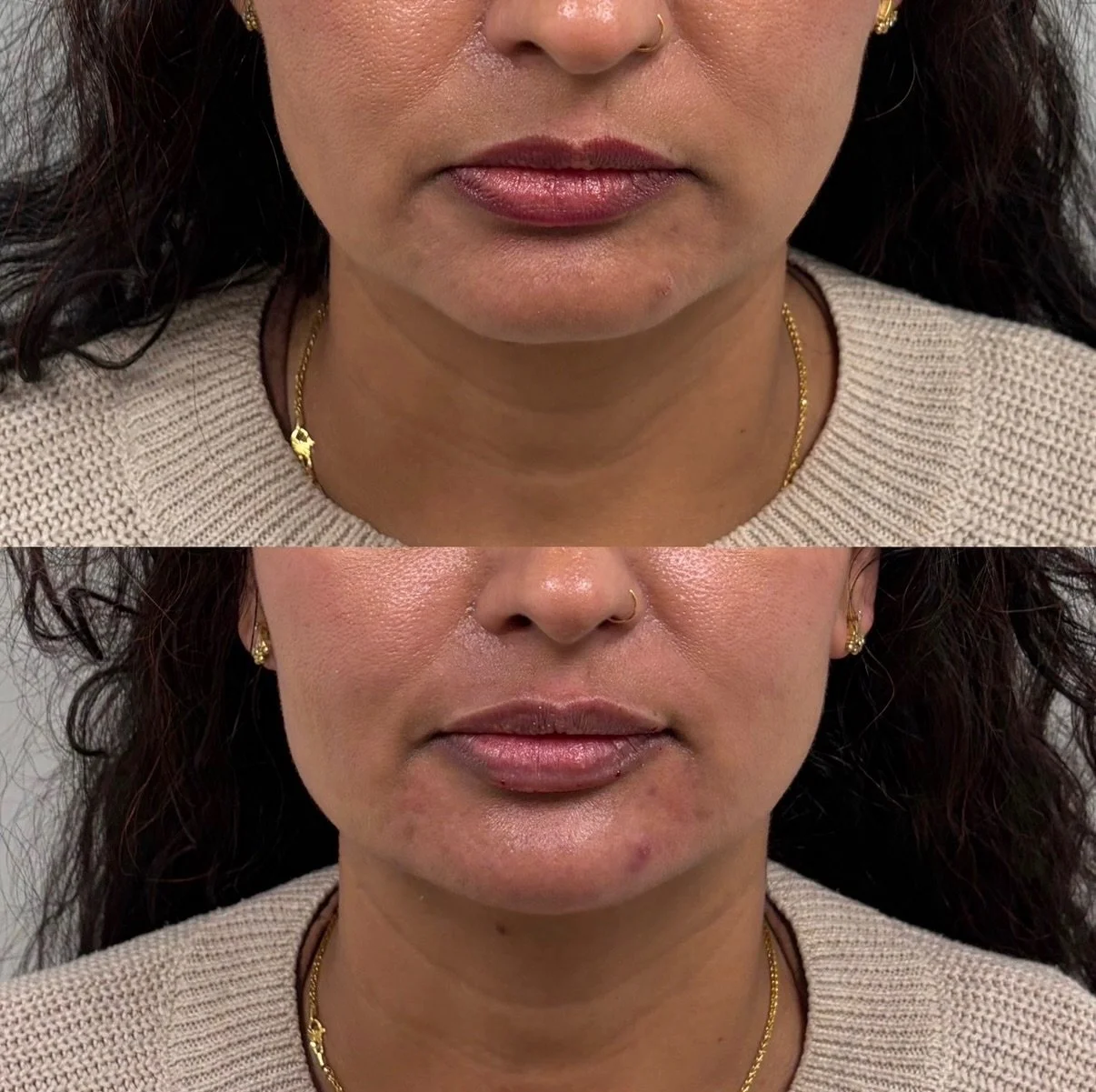 Lower face trifecta: lip, chin, and chin shadow filler compliments each other so well and creates a seamless appearance for the lower face.

This is how you achieve undetectable injectables 🧐

🤎by Lily