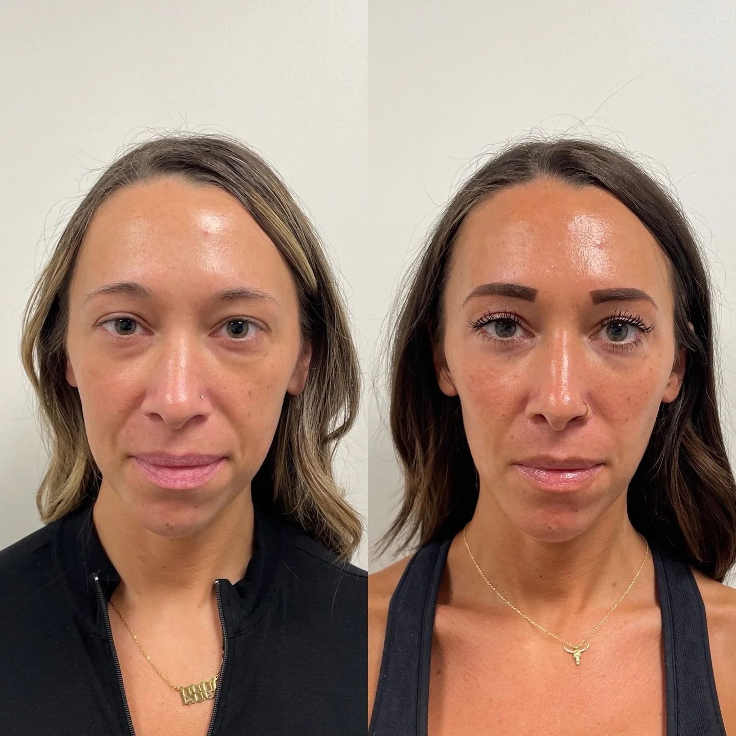 A comprehensive treatment plan tailored to your aesthetic goals will lead to the greatest outcomes. We use different modalities to treat different concerns keeping in mind that the overall goal is a slightly enhanced version of you. We are not trying