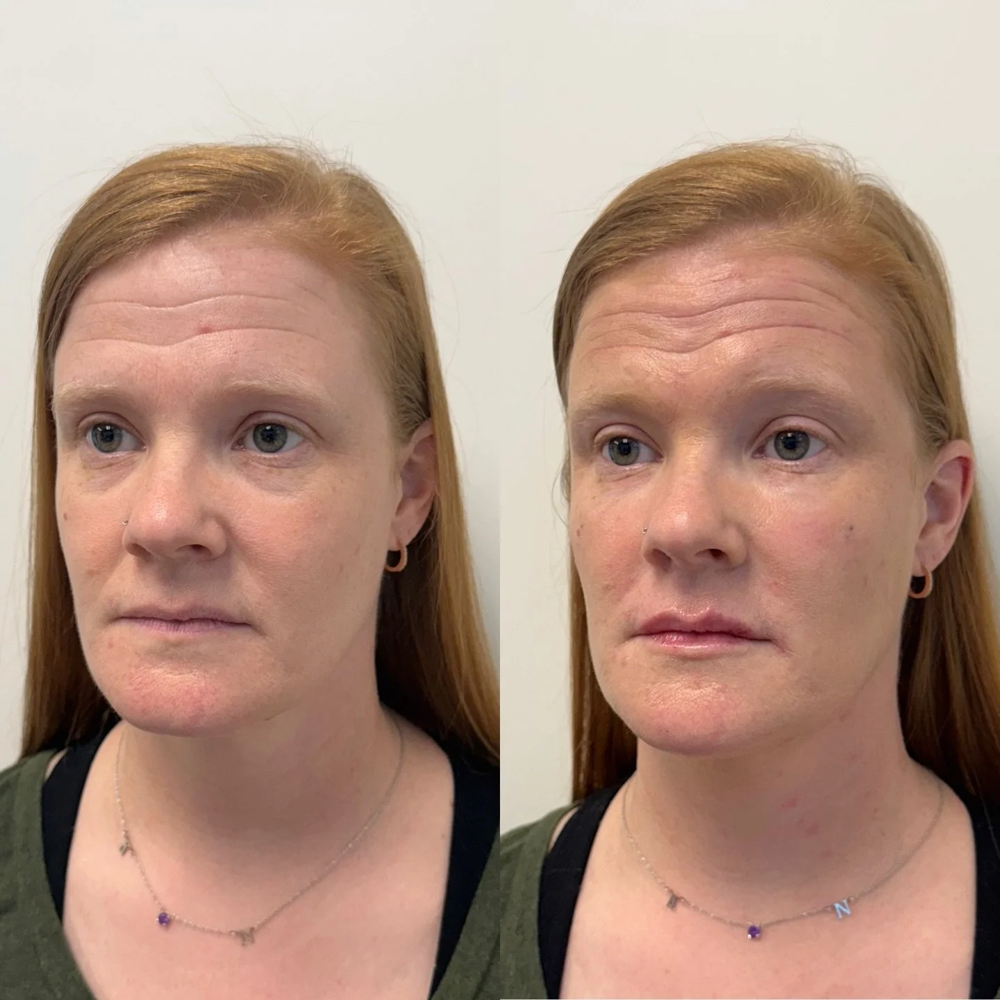 Both dermal filler and botulinum toxin need time to fully settle before their final result is revealed. While you may notice changes immediately after treatment, the most refined, balanced outcome is typically seen around 2&ndash;3 weeks later.

📸 P