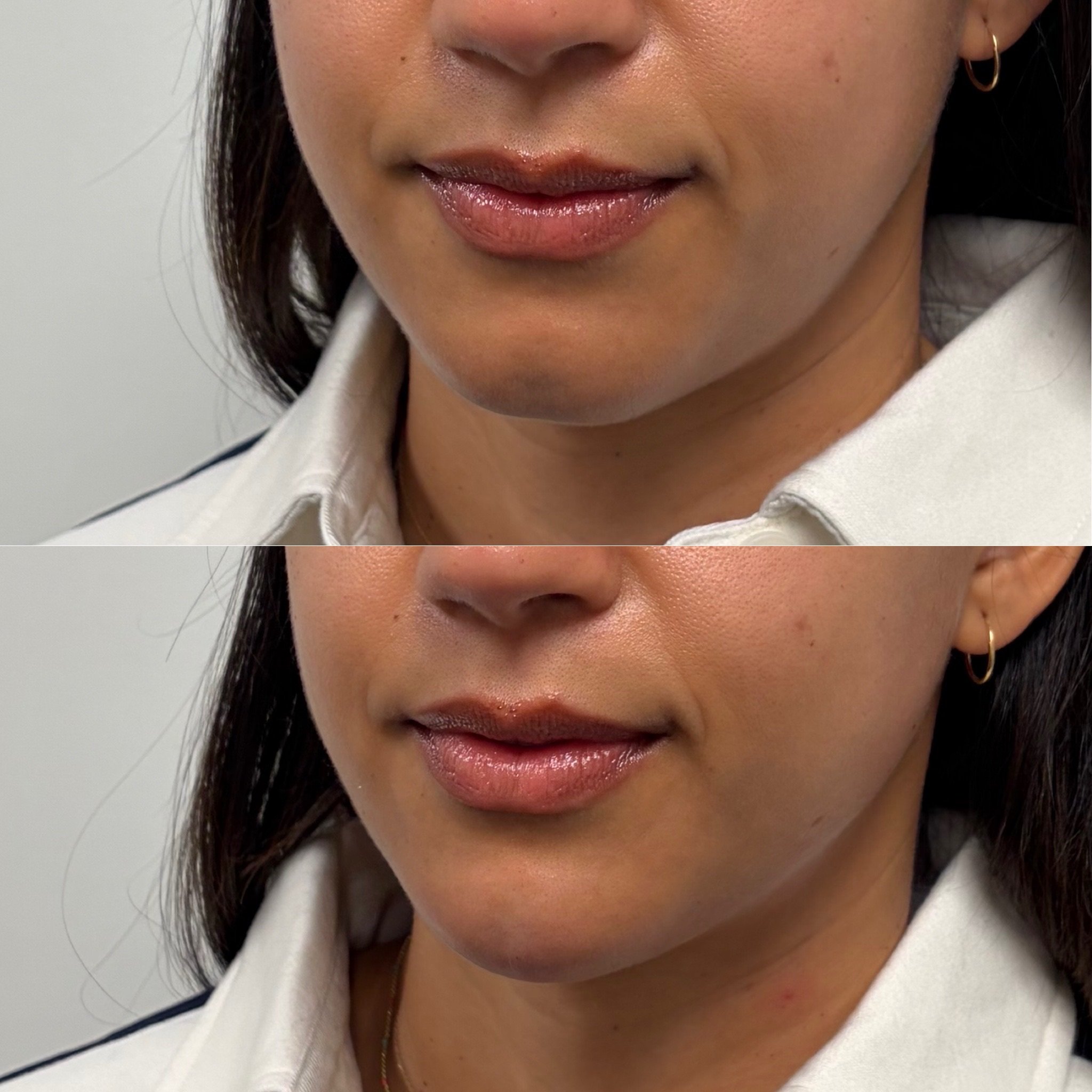 When this patient came in for a full face assessment, I had recommended under-eye and chin filler. I treated her under-eyes first as it was her main concern. She then came back wanting a more defined jawline and to soften her chin. I used one syringe