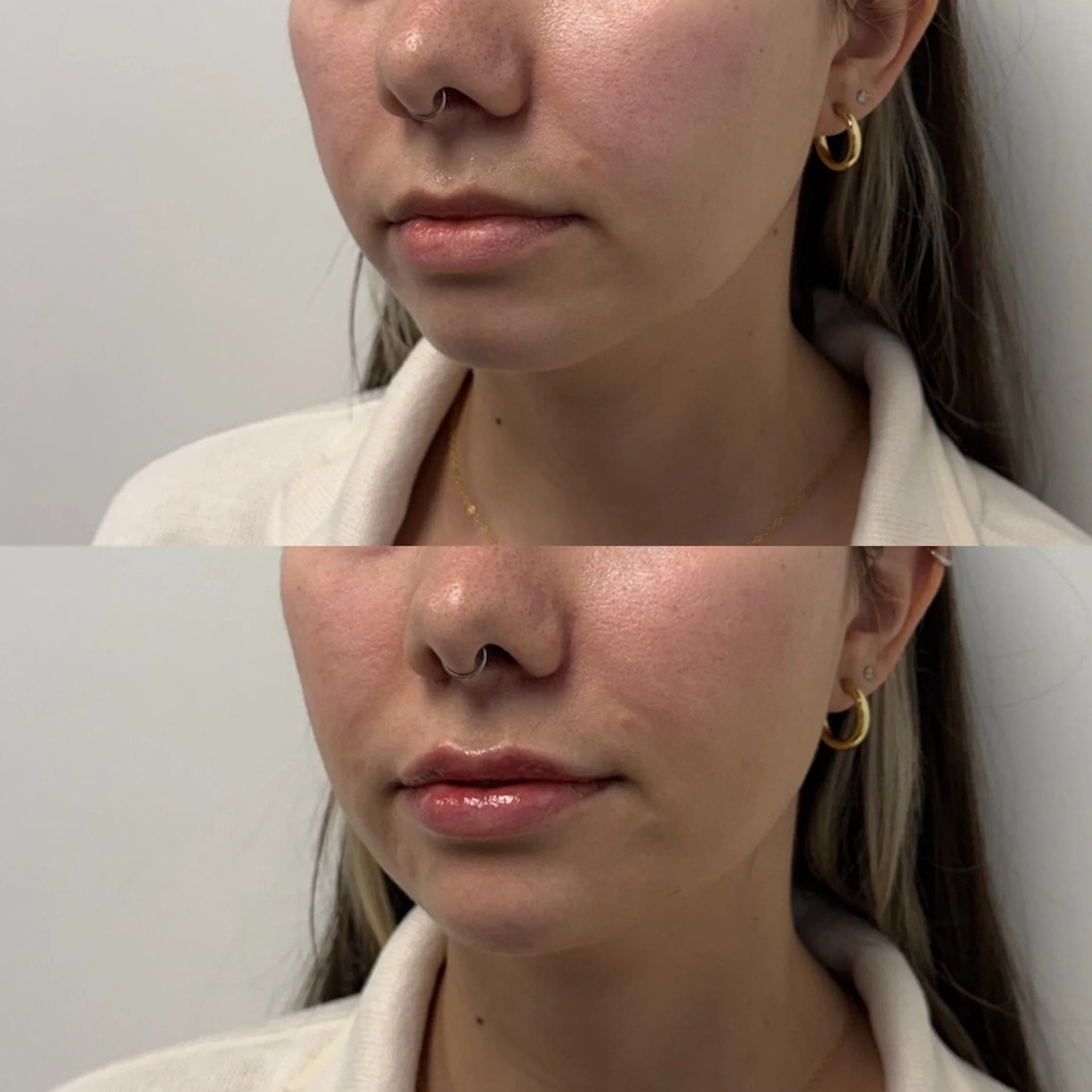 Only about 1% of my patients can JUST get lip filler without getting it anywhere else.

To keep things balanced and natural, the chin and chin shadow often matter just as much.

When all the volume lives in the lips, that&rsquo;s when you look like y
