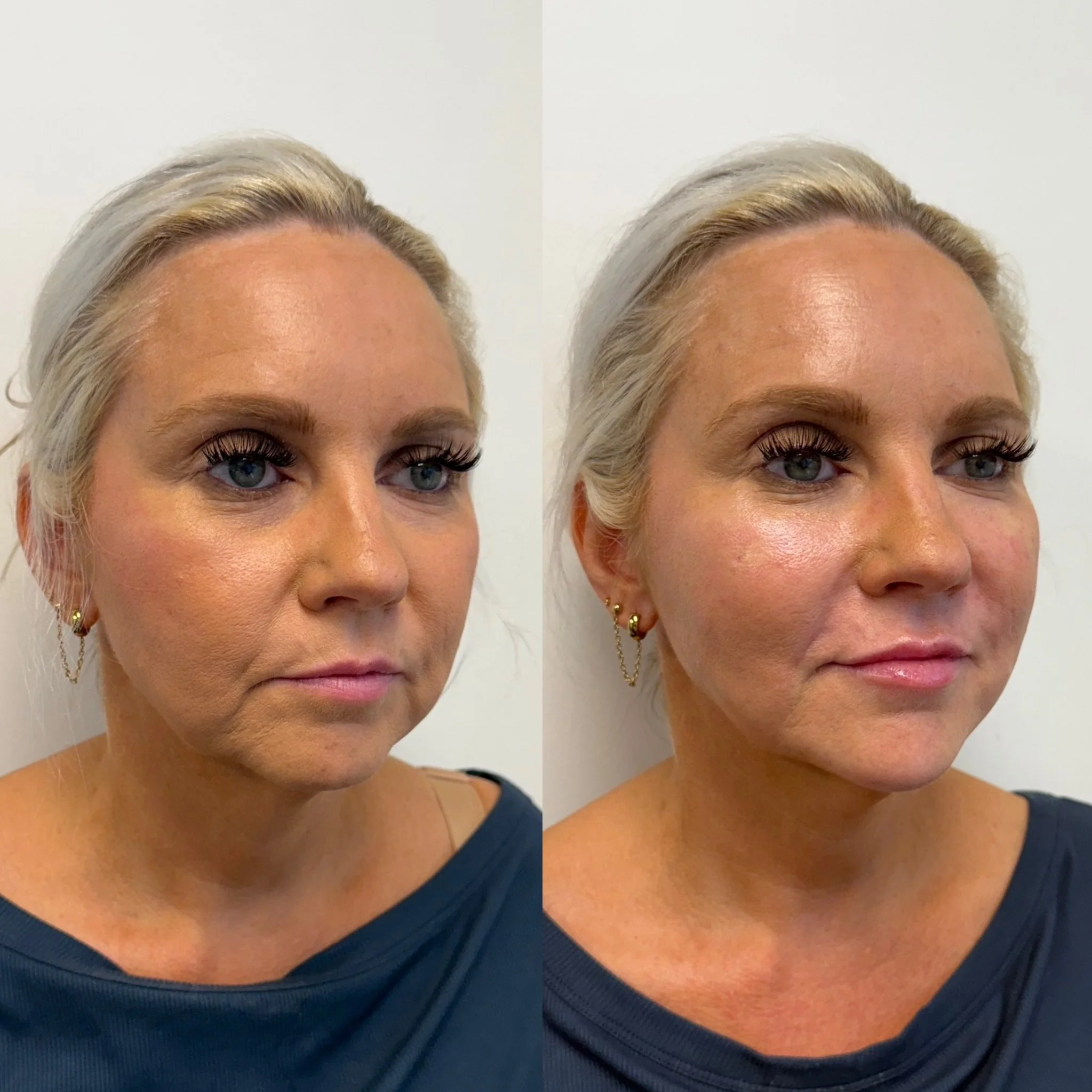 She thought injectables simply weren&rsquo;t for her until she experienced what a customized treatment plan and the right injector can achieve. Now she says she has never been happier with her results🫶🏼

We did 4 syringes of filler and a full face 