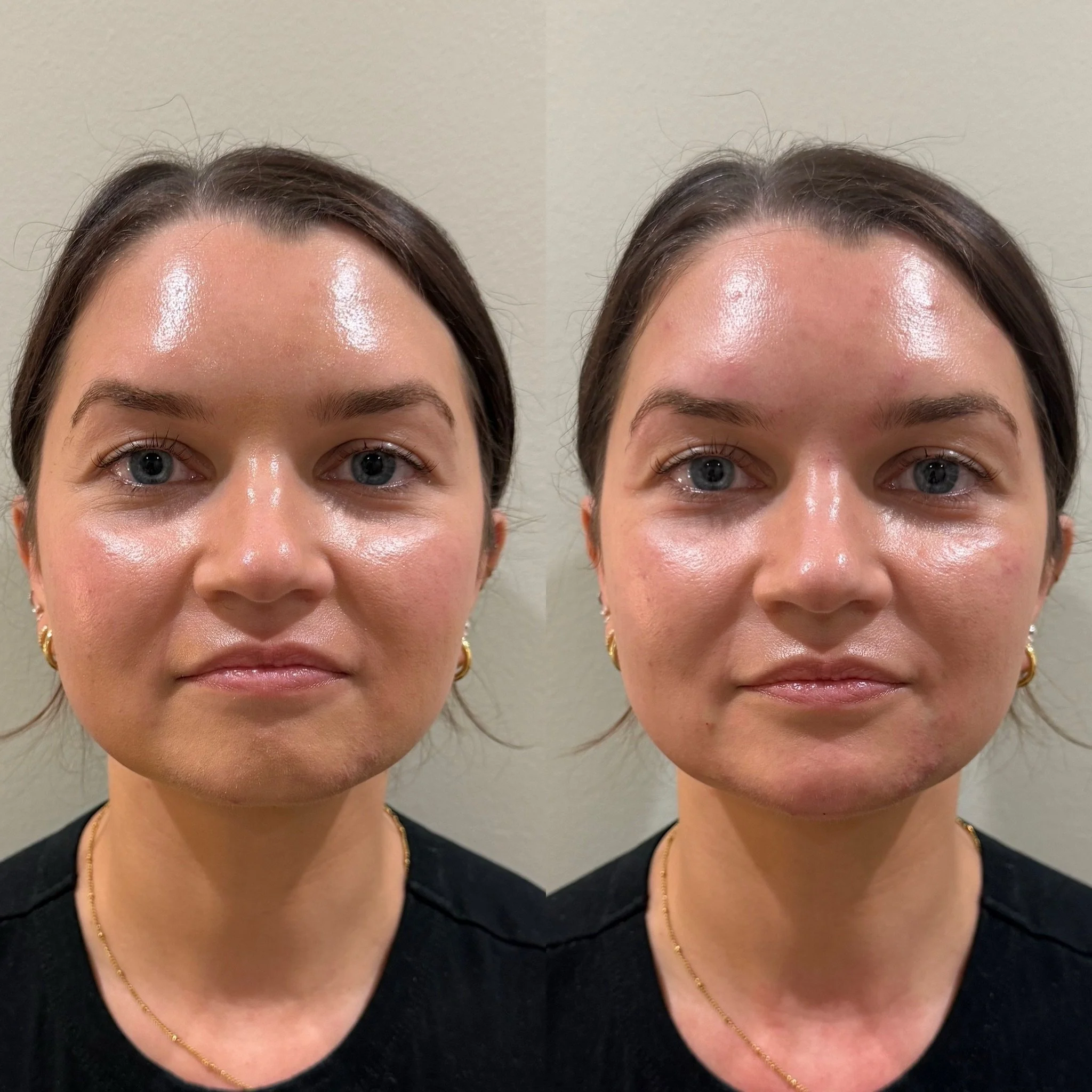 When she came in for a full-face assessment, she was concerned was that her face felt too round and that her cheeks were too big. Don&rsquo;t worry, Andrea and I yelled at her and told her that her  cheeks were actually perfect.

Volume in the face i