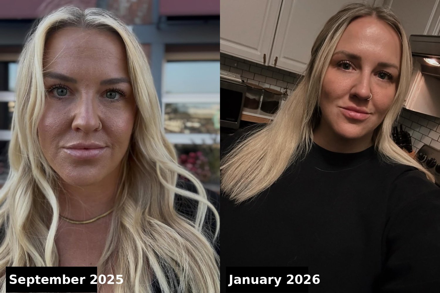 Molly's Instagram posts show how her face transformed between September 2025 and January 2026