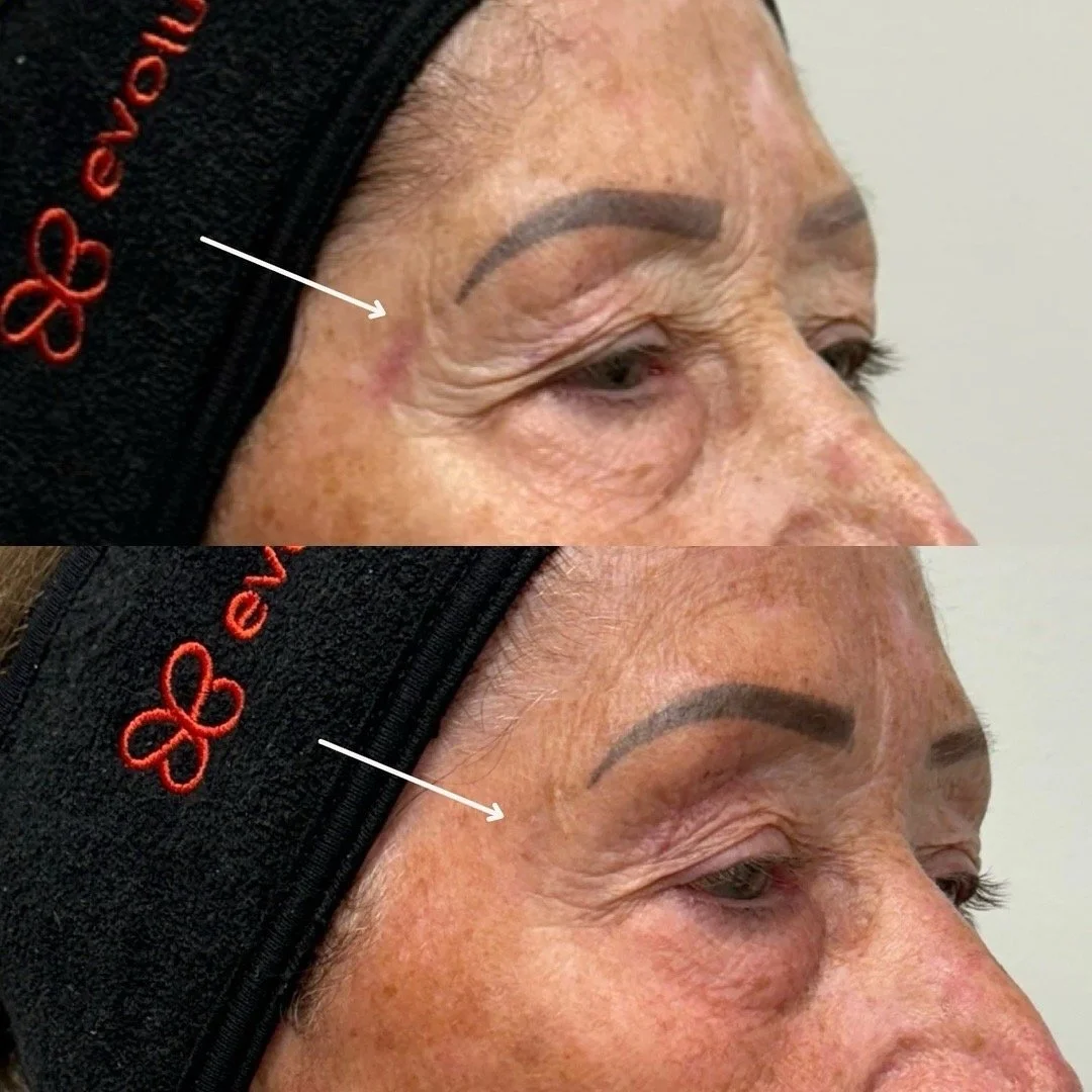 Before & After photos of a patient. Treatment: 6  Sylfirm X sessions every 4 weeks, with topical exosomes applied immediately post treatment.