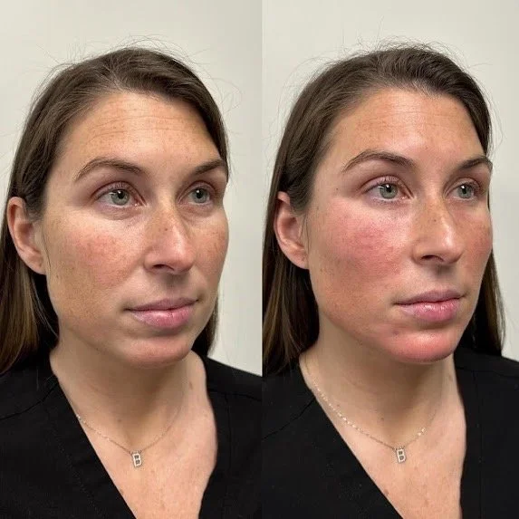 Before & After photos from a dermal filler patient of Stepanie Stewart, PA-C