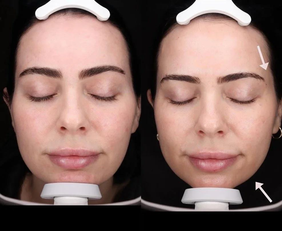 Results of a single Sylfirm X session. Observe fuller temples, smoothed under-eye wrinkles, tighter jawline and chin, and an overall lifted and firmer look.