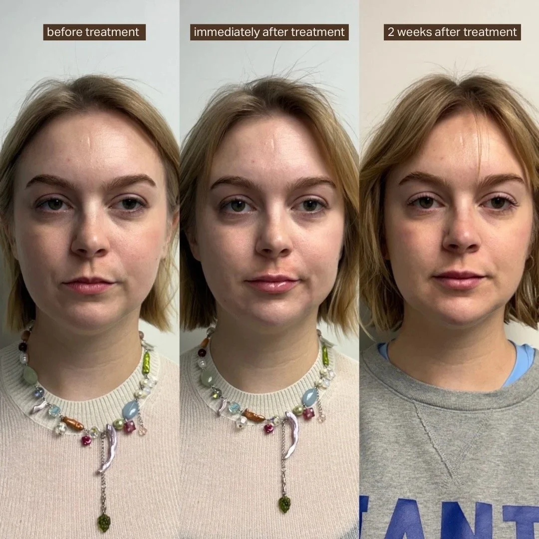 Transformation 2 weeks after HA Filler injection (midcheek, lip, chin, and chin shadow) by Dana Hasselschwert, RN, BSN