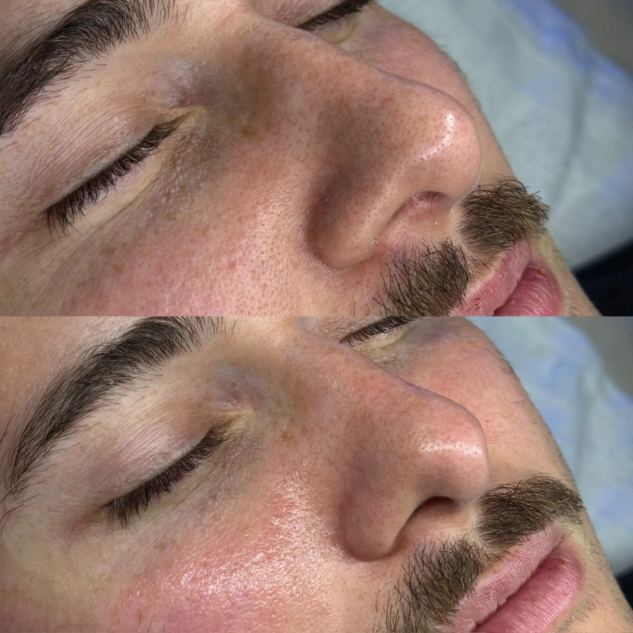 HydraFacial Before and After