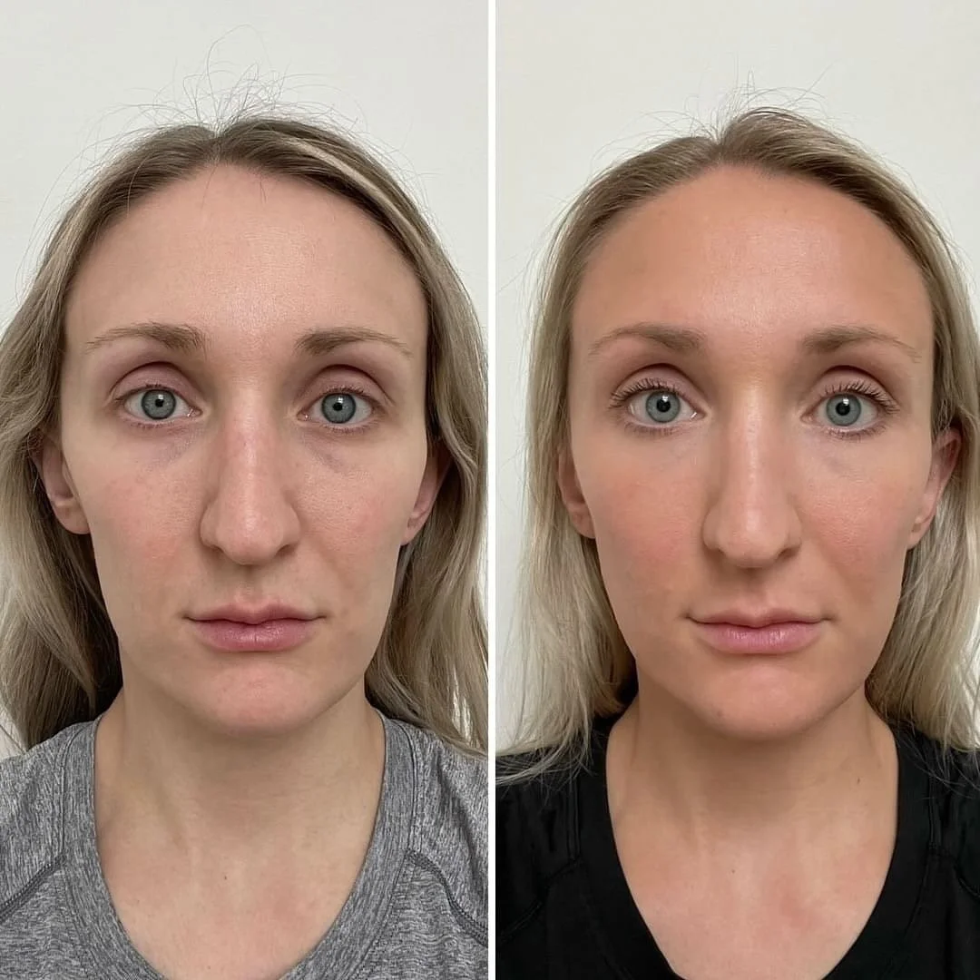 A patient’s results after three RF Microneedling sessions
