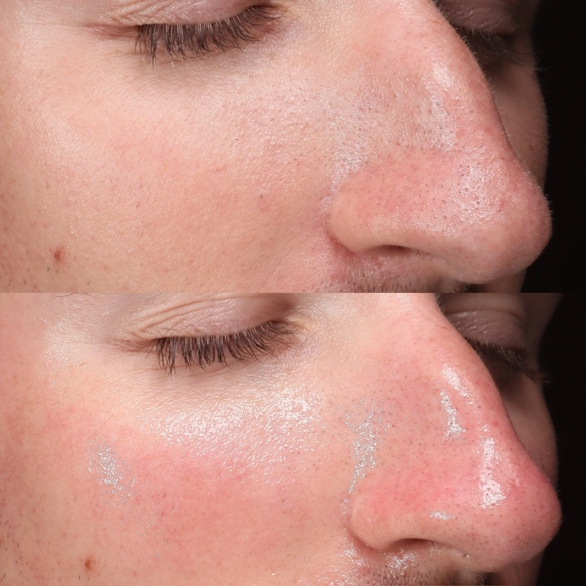 HydraFacial Before and After