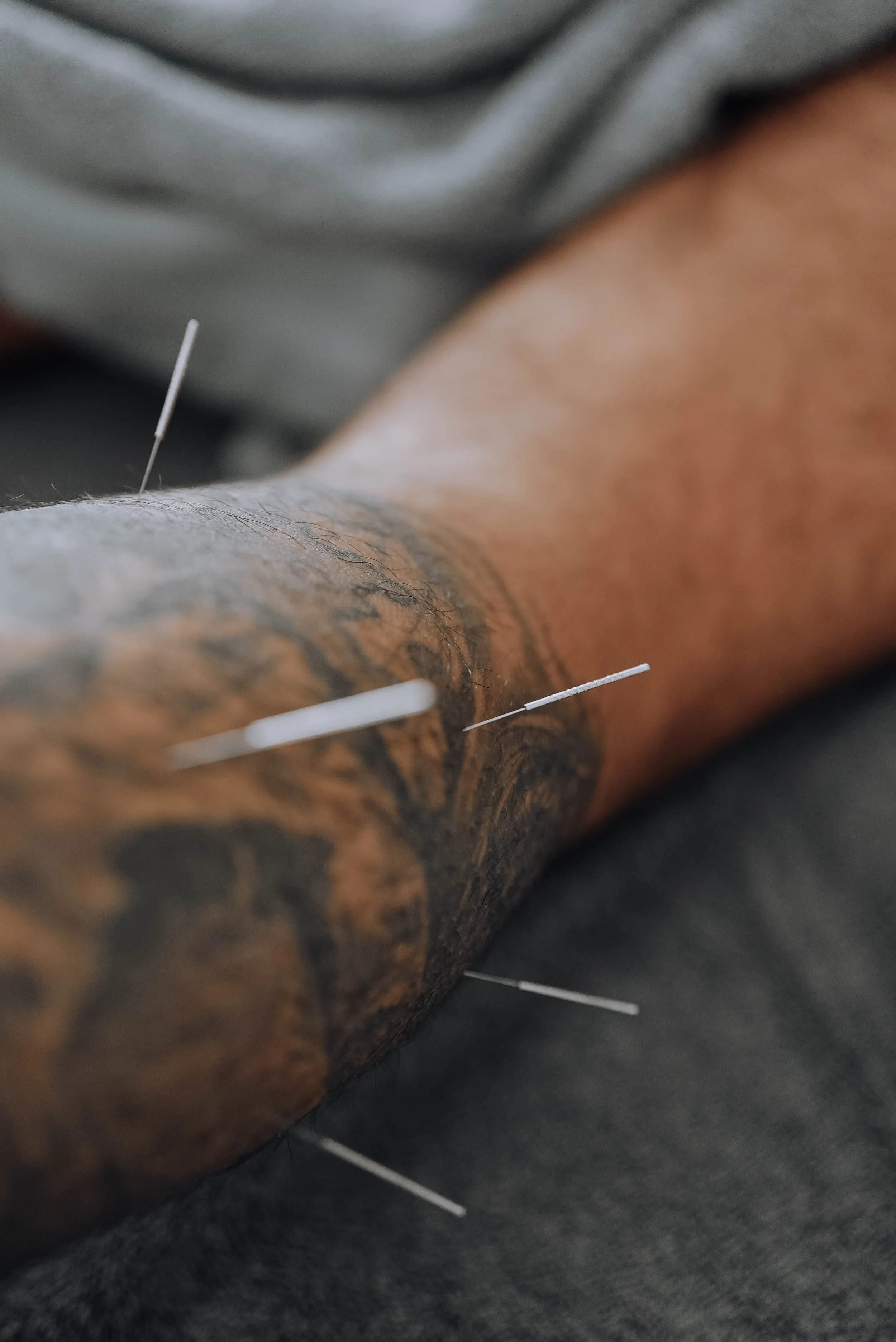 Dry Needling at Medela: What It Is, Why We Use It, and How It Fits Into Your Treatment