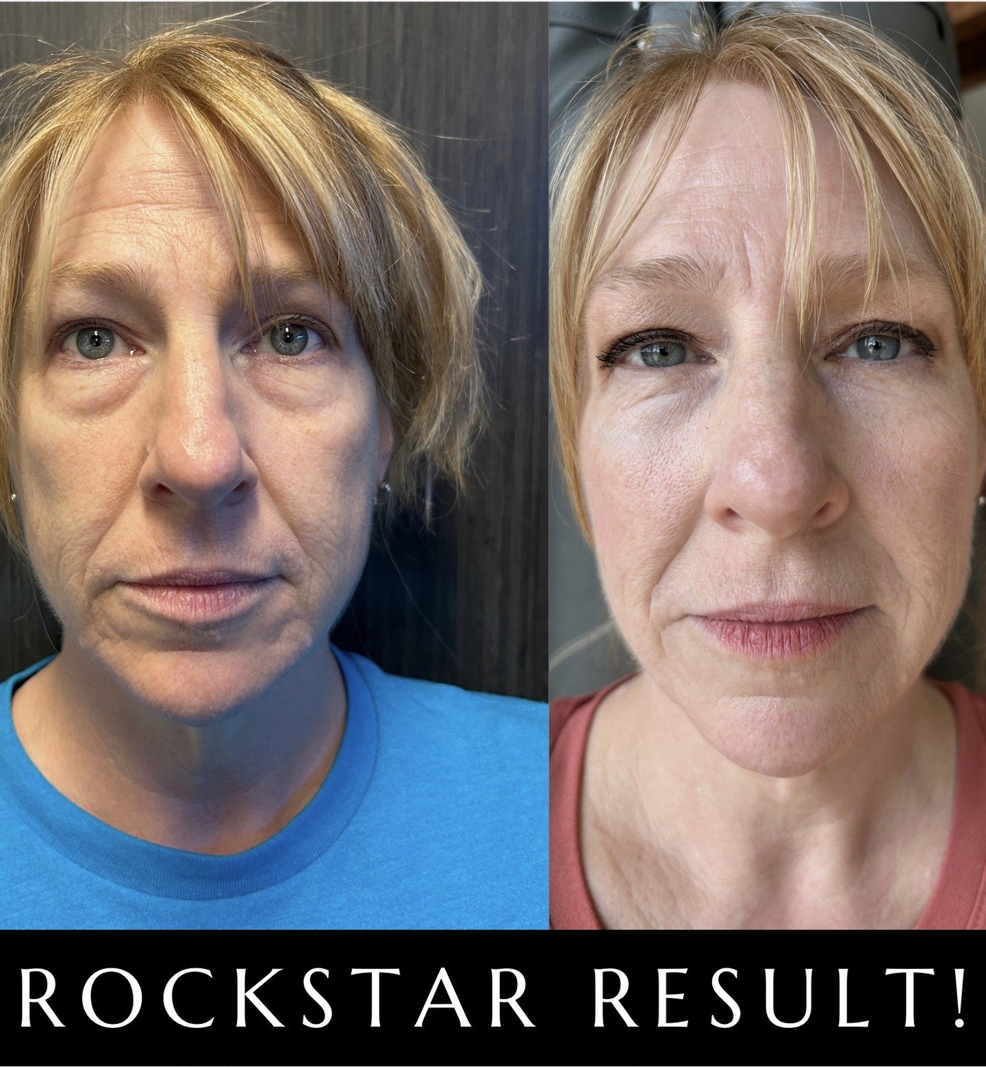 Most Scarlet owners would be ecstatic for a result like this after a total of 3 treatments. I got this after ONE. How? Extra steps like the IV infusion given at the same time. No one wants good, when they can have amazing.
📞 480 622 4425
www.Sanctua