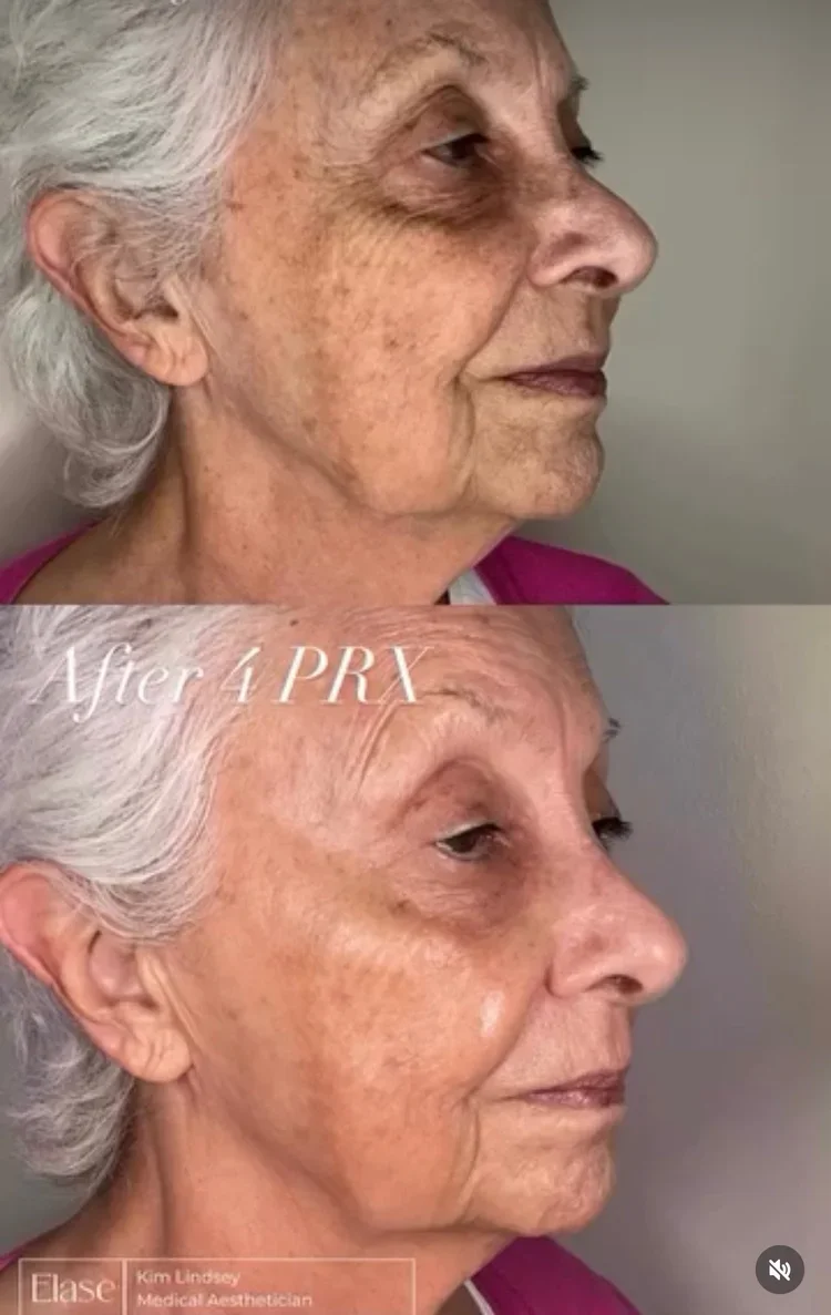 PRX treatment by marco island aesthetics. Side-by-side comparison of an elderly woman's face, showing before and after facial treatment. The 'after' side has smoother skin, fewer wrinkles, and a more youthful appearance.