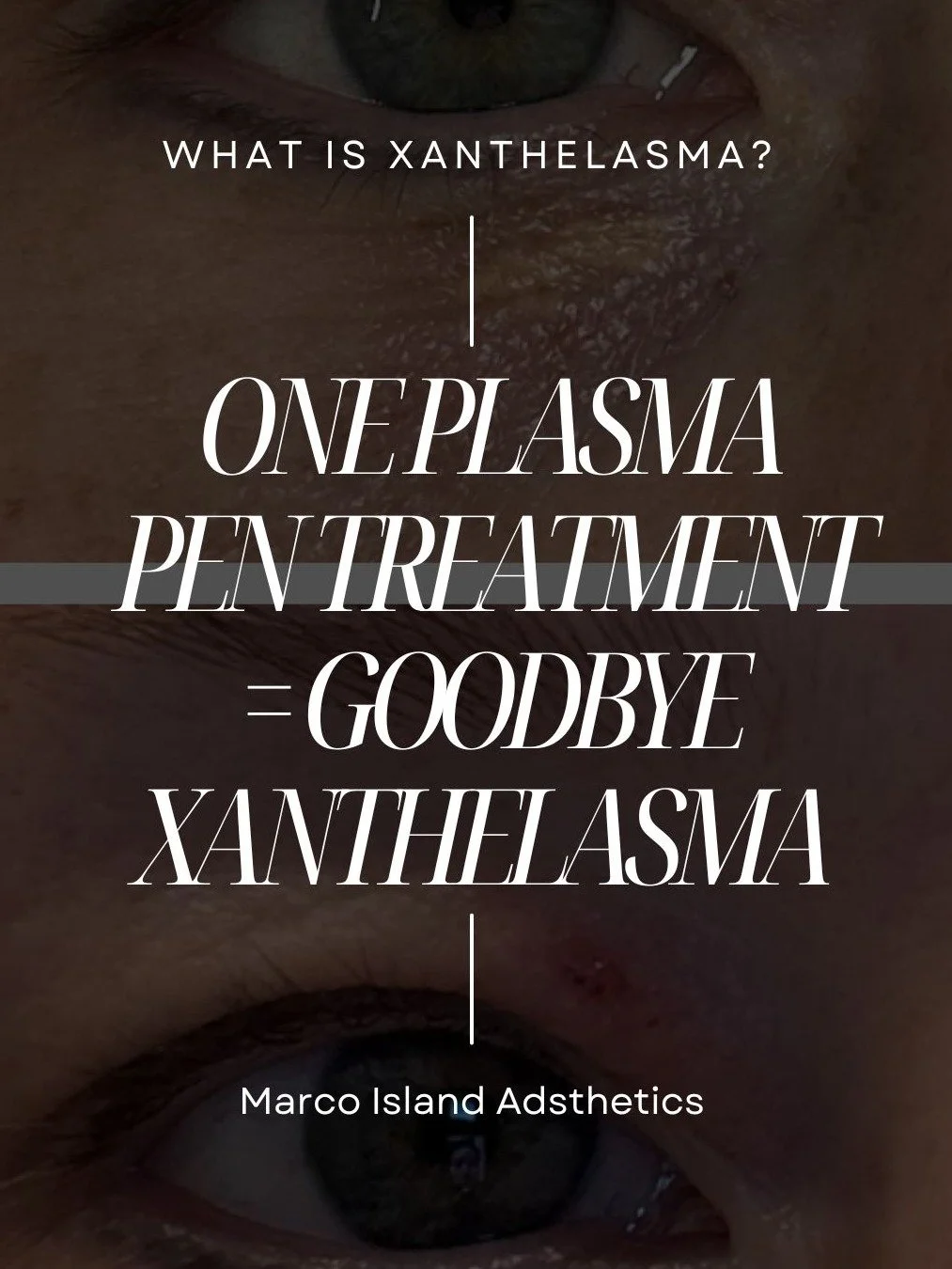 ✨ ONE PLASMA PEN TREATMENT = GOODBYE XANTHELASMA ✨

Meet our amazing client who said "no thanks" to those stubborn yellowish deposits around her eyes! 

What is xanthelasma? It's a buildup of cholesterol deposits that appear as yellowish bu