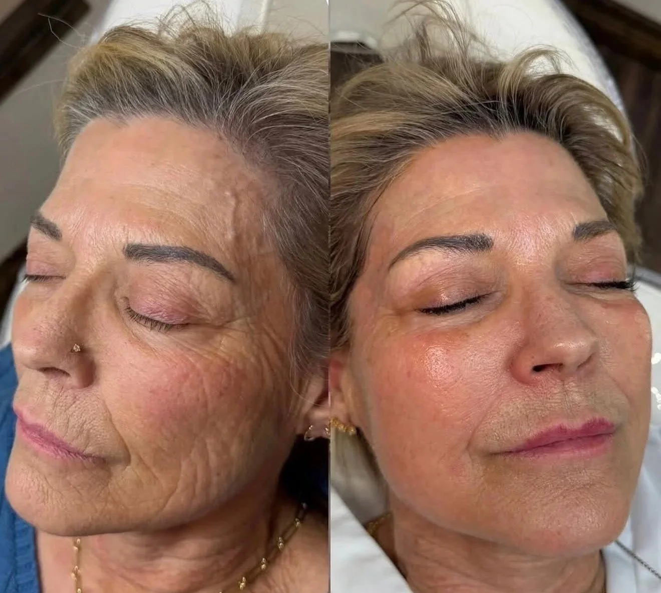 Venus Freeze at Marco island aesthetics