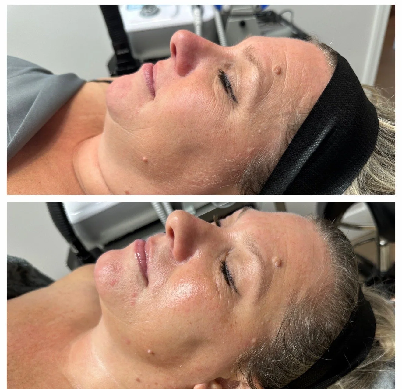 Side-by-side before and after images of a woman with glowing skin during a skincare treatment, lying with eyes closed, wearing a purple headband and a purple top.