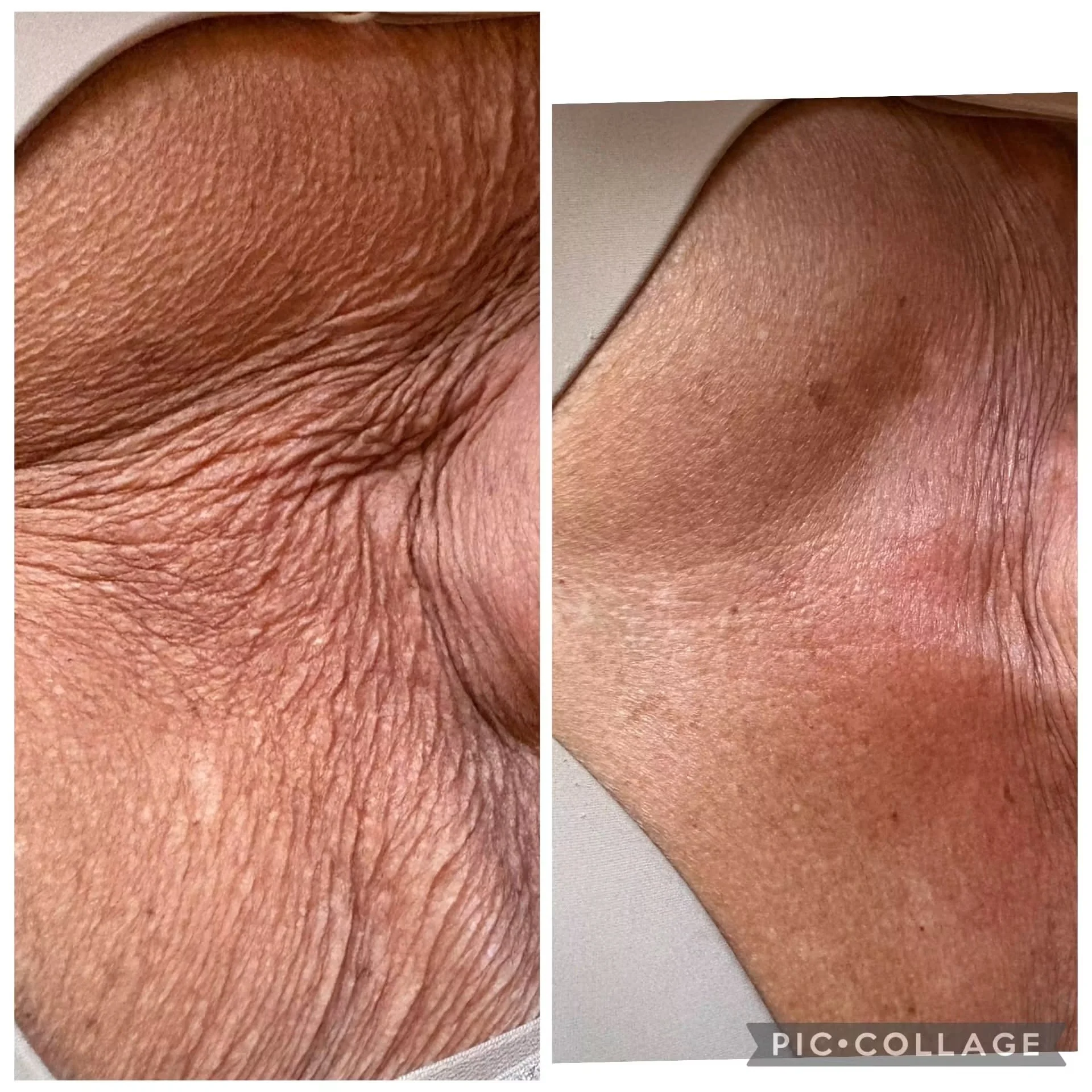 PRX treatment by marco island aesthetics. Close-up of skin showing comparison between aged skin on the left with wrinkles and rough texture, and younger skin on the right with smooth and firm texture.