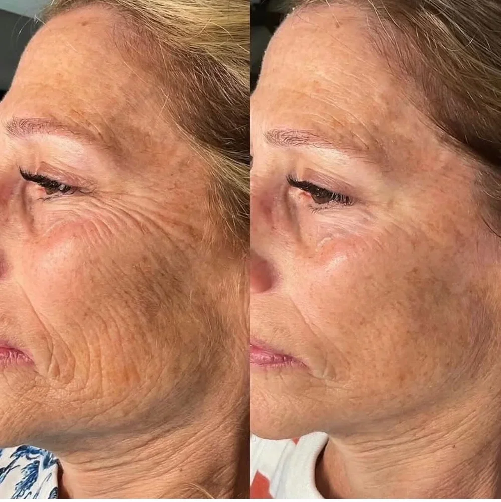 Side-by-side comparison of a woman's face showing reduction in wrinkles and skin improvement, before and after skincare treatment.PRX treatment by marco island aesthetics.