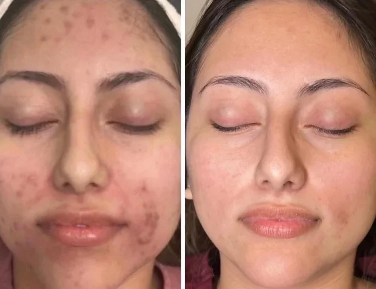 Side-by-side comparison of a woman's face before and after treatment showing significant improvement in acne and skin clarity. PRX treatment by marco island aesthetics.