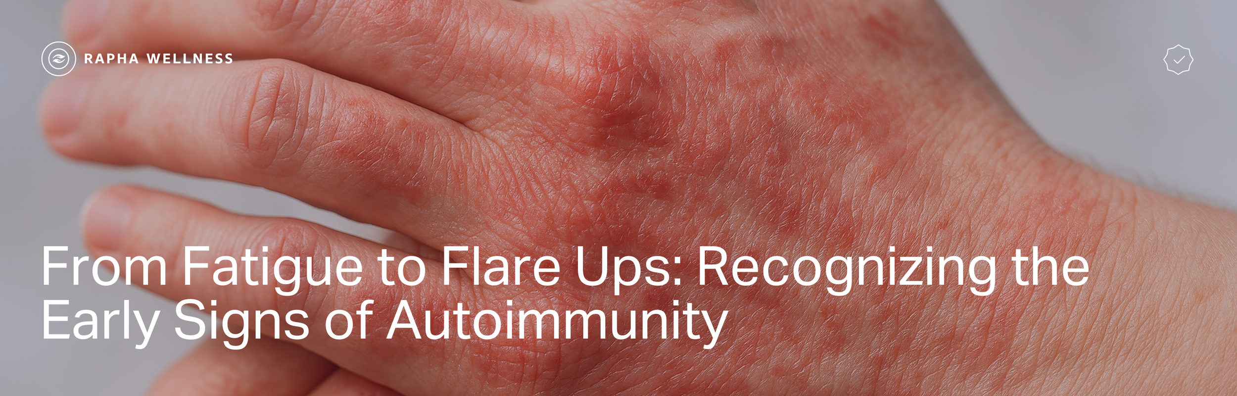 From Fatigue to Flare Ups: Recognizing the Early Signs of Autoimmunity ...