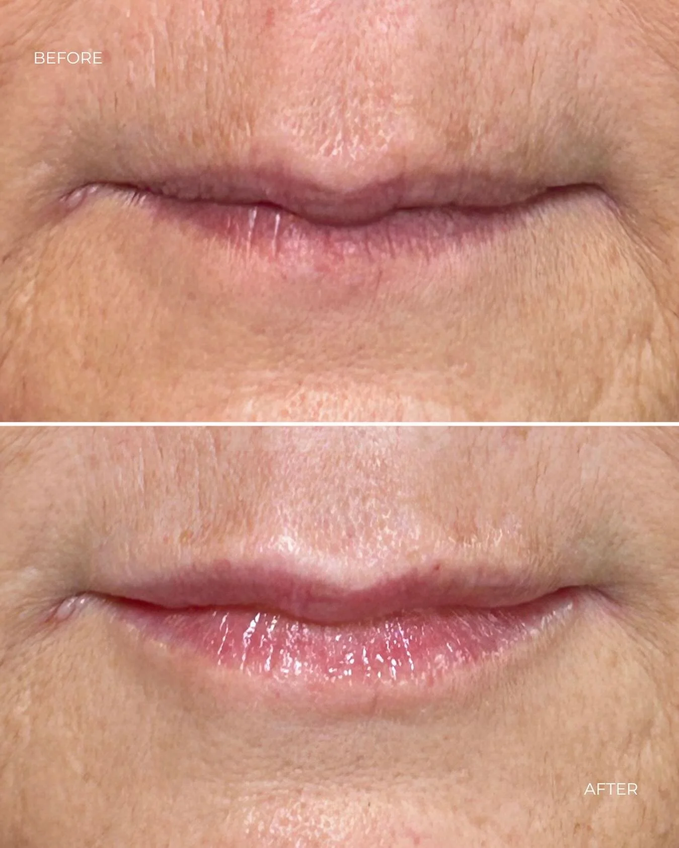 ✨LIP FILLER - 0.5ml✨

Sometimes less really is more!
With just 0.5 ml, we added volume, contour, and definition, keeping it soft and smooth.
#lipgoals #naturallips #beforeafter #fillerartistry #enhancenotchange #lipsbynuse