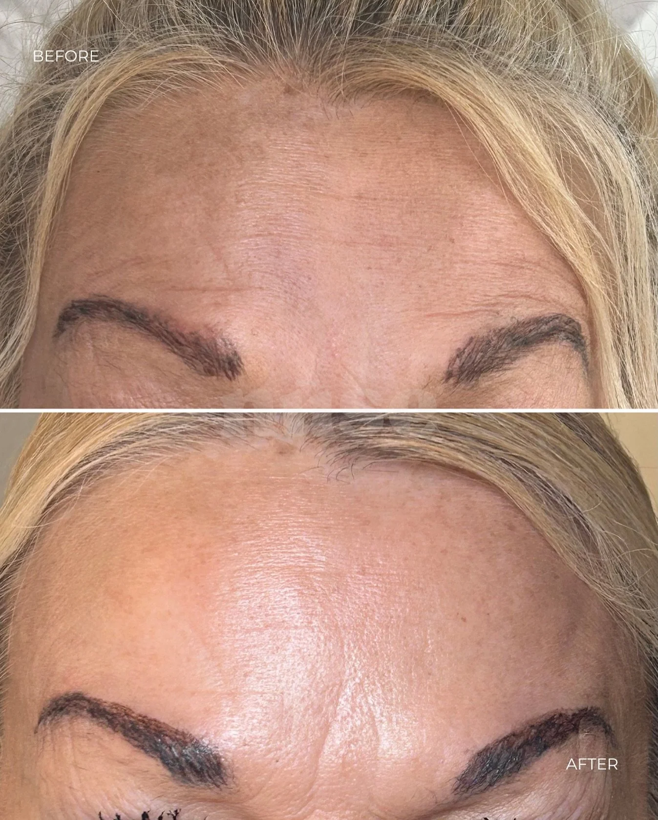 ✨ 2-week review &amp; top-up ✨

This lovely client came back for her anti-wrinkle review yesterday, a small top-up was done for that final smooth finish 💉✨

Beautiful, natural movement with softened lines and a refreshed look 🤍

📍Aspley, Nottingha