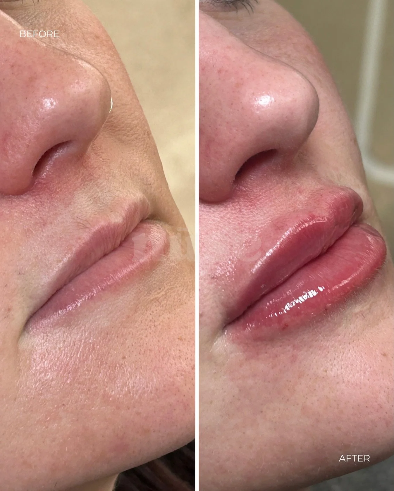 Fresh lips, who dis? 💉

Subtle volume, hydrated finish &amp; that glossy glow, just perfection 😍

Appointments available evenings &amp; weekends ✨
📍Aspley, Nottingham
💋 Book Now via Link in Bio

#lipgoals #fillerbynuse #nottinghamaesthetics #juic