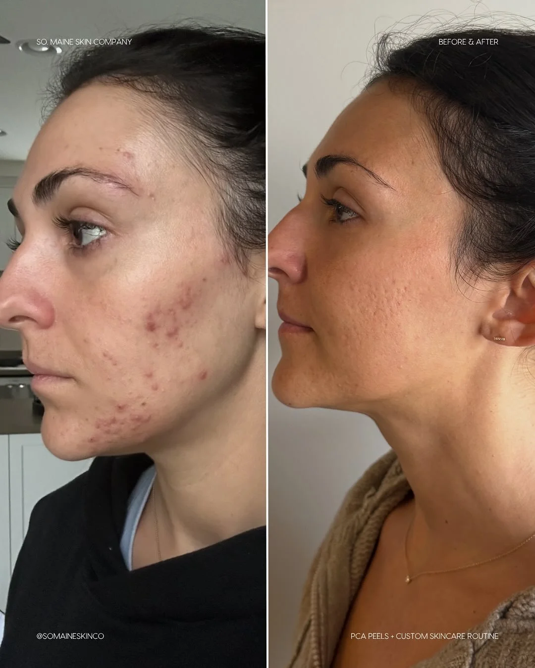 Trust the process 🖤 A before, during &amp; after of a series of PCA peels with a custom at home regimine is where the results come from! If you&rsquo;re looking for results but aren&rsquo;t sure how to get there, let&rsquo;s chat! We&rsquo;re happy 