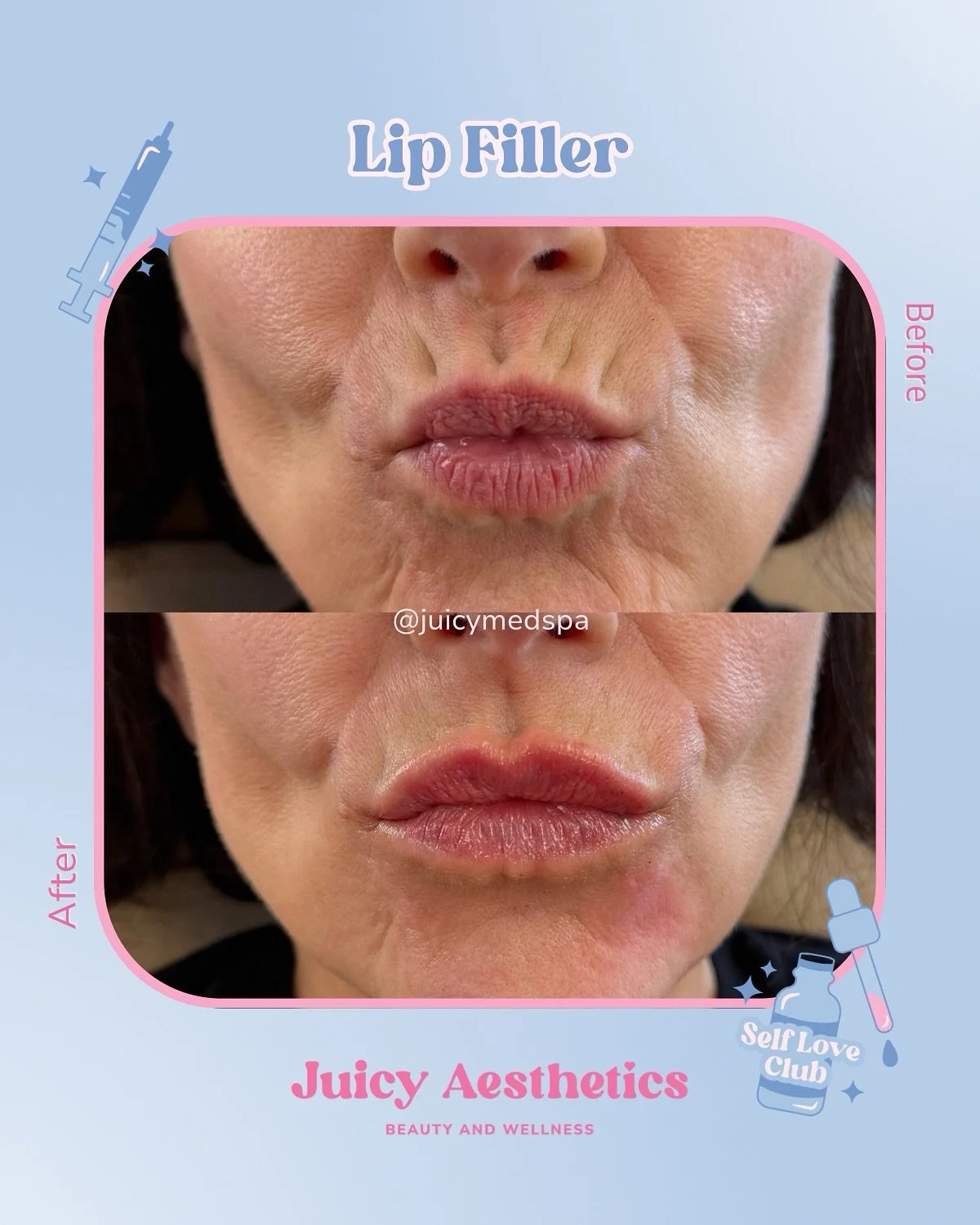 Lip filler isn&rsquo;t always about plumping💋
A little bit of filler can help smooth out those pesky &ldquo;smoker lines&rdquo; (even if you&rsquo;ve never touched a cigarette 👀) AND restore hydration so your lips look soft, supple, and refreshed. 