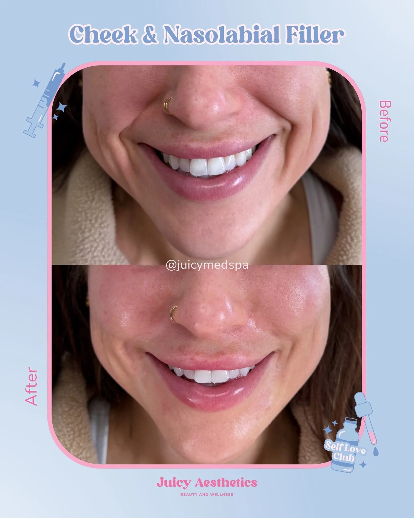 Look at this MAGIC @npmirandarose made!! Five years shaved off just like that 👏🏼 this filler will continue to settle as the swelling goes down producing albeautiful smooth results. 

Often with our GLP-1 clients we see volume loss in the lower face