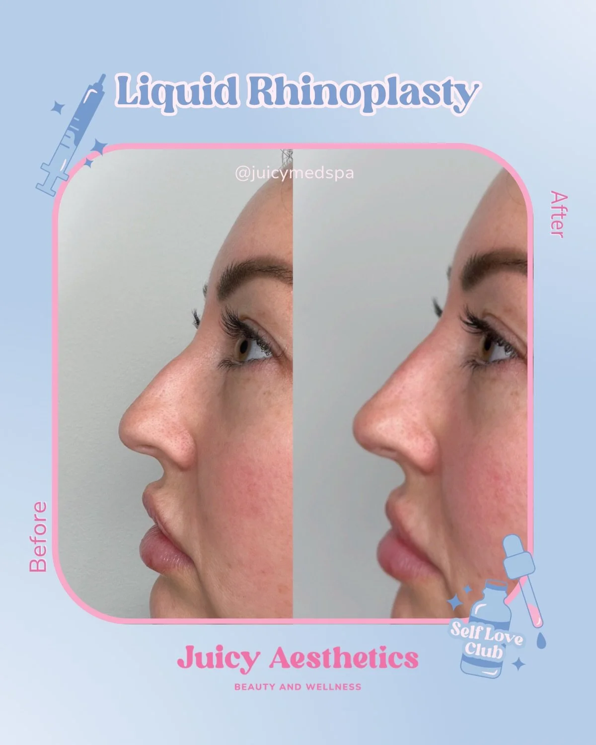 NEW SERVICE ALERT 💥 we are BEYOND EXCITED to now offer LIQUID RHINOPLASTY at Juicy Aesthetics 😍 LOOK AT THESE BEAUTIFUL BEFORES AND AFTERS OMG. 

Liquid Rhinoplasty is a non-surgical treatment where we use injectable filler to smooth bumps, lift th