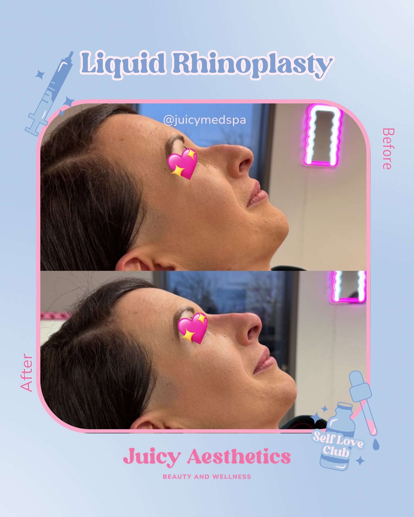 We are beyond obsessed with all of our Liquid Rhinoplasty results!! A new nose within the hour using filler only&mdash; ICONIC. And seeing the look on our patient&rsquo;s faces when they see the results? Priceless 🥲

💉 Liquid Rhinoplasty 
💰 $1,350