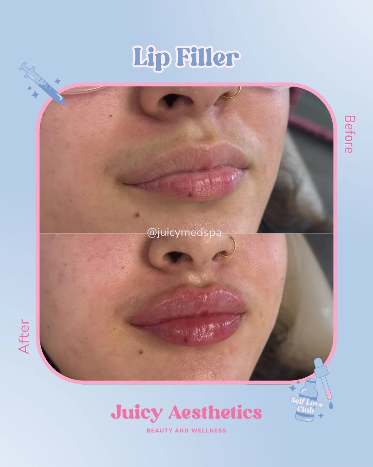 Hydrated for the holidays 🫧 it&rsquo;s not too late to have your dream lips for NYE 💋 sneak in here asap after Christmas, babes&mdash; we&rsquo;ve got you 🫶🏼 

💉 Lip Filler
💳 $700
⏰ Lasts 6- 24 months 

📍 Juicy Aesthetics
3305 Main St. STE 301
