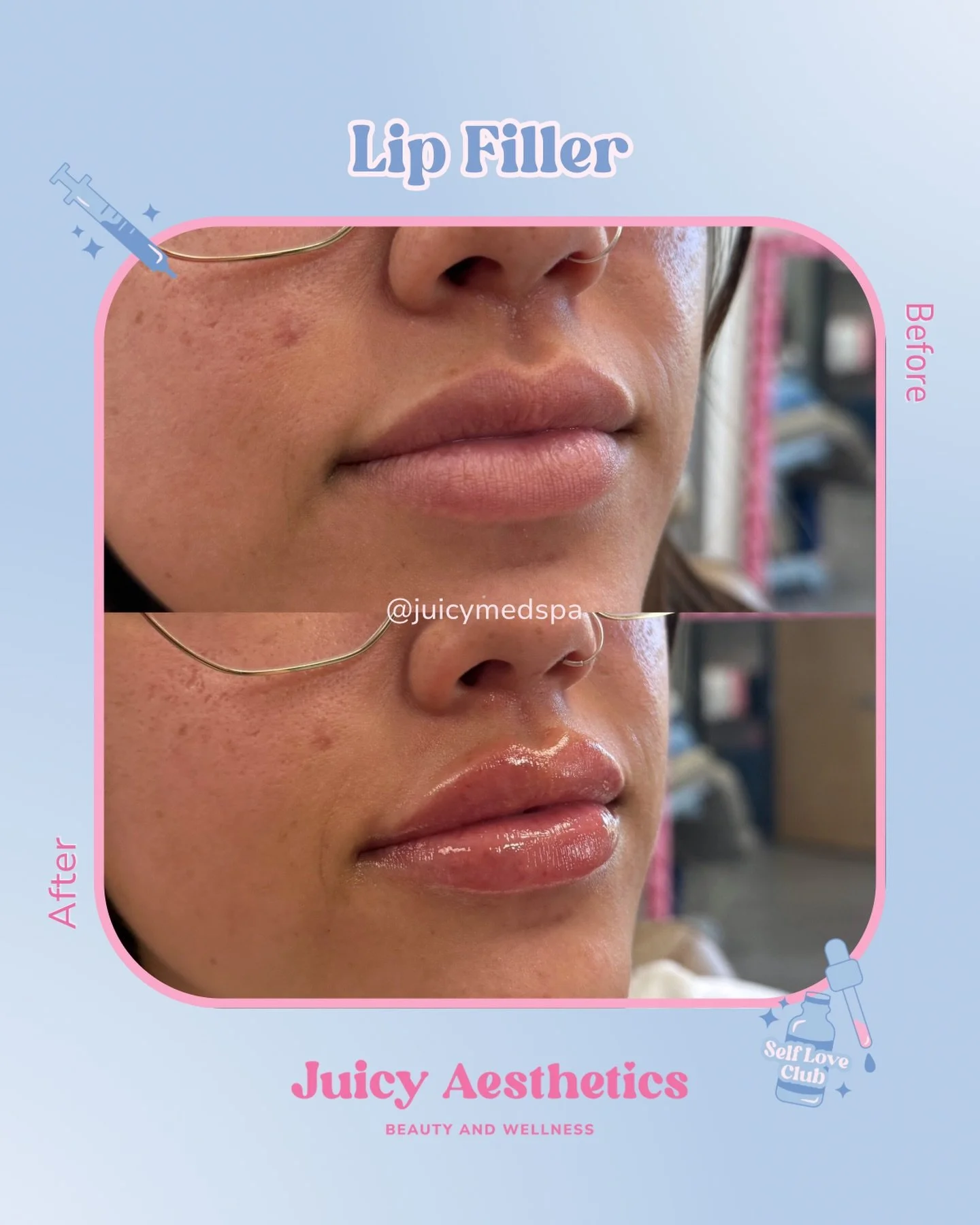 Your face&hellip; just Juicier 💋✨ trending in 2026 is subtle enchantments and we are LIVING for it 😍

Think: hydrated, balanced, and &ldquo;is she just naturally pretty?&rdquo;

Not overdone.
Not obvious.
Just elevated, enhanced, and Juicy.

Nervou