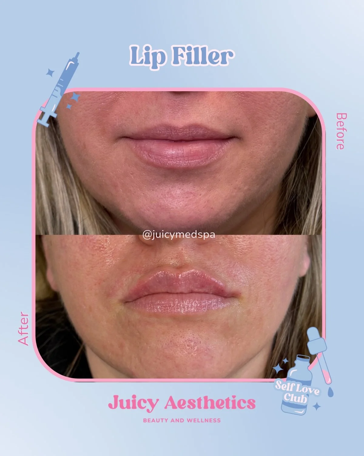 My favorite animal is @injectorjuicy when she adds height and volume to an upper lip while keeping the original shape 😮&zwj;💨 your lips&hellip; only Juicier 🍓💦 

📲 Book under Treatments &mdash;> Injectables &mdash;> Lip Filler
LINK IN BIO 