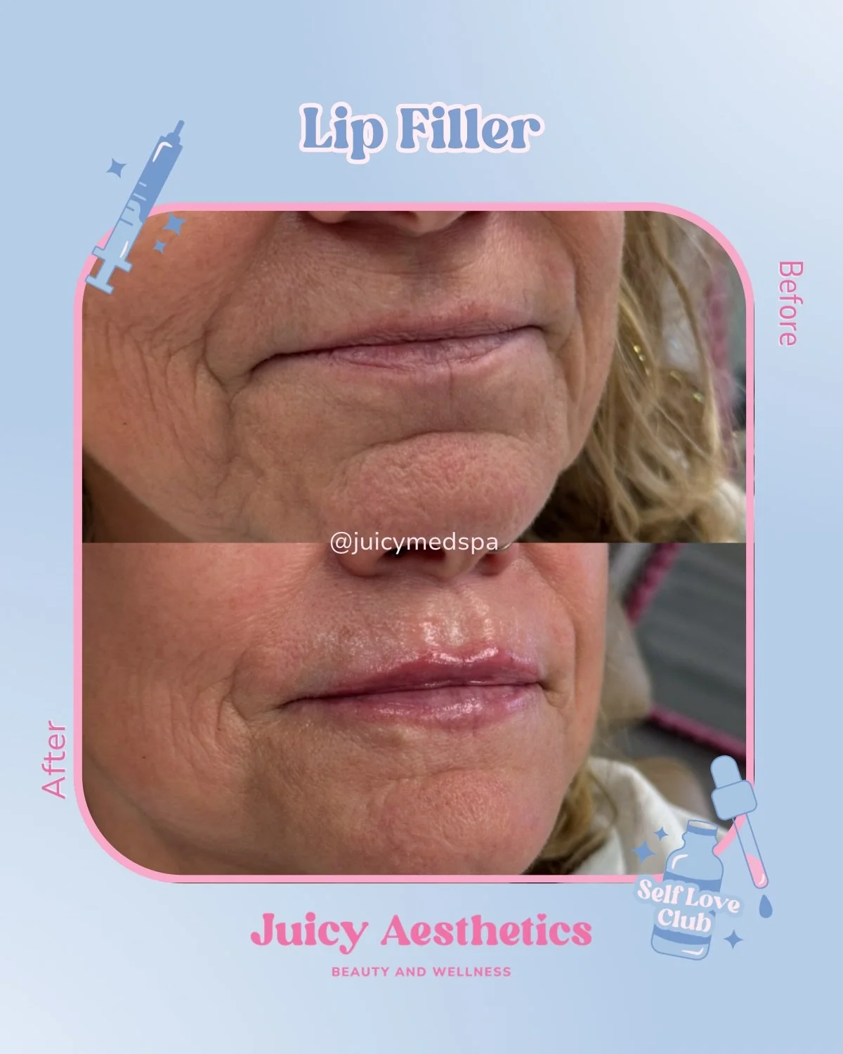 When we say, &ldquo;Natural, Juicy results&rdquo; THIS is what we mean 😍 look at those cutie philtrum columns! They are perfection.

We can add volume while maintaining your natural shape, essentially accentuating what your mama gave you 😉 

💋 BOO