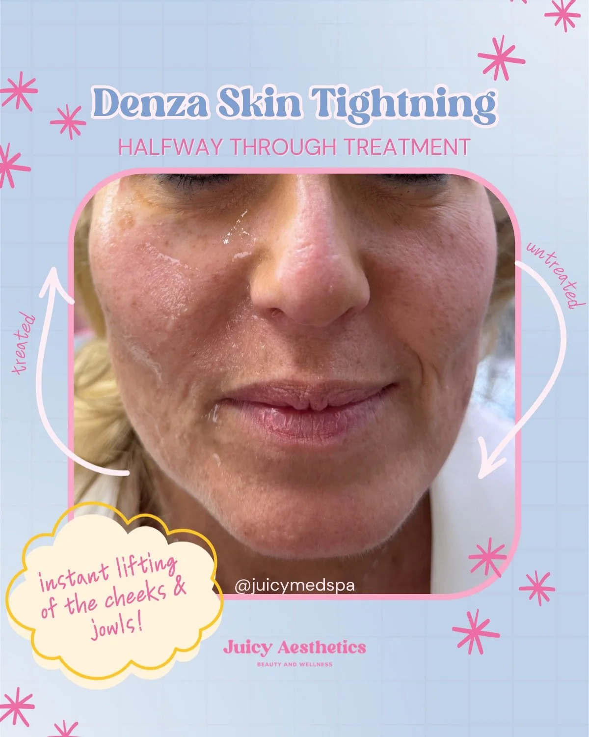 Our most underrated treatment? DENZA SKIN TIGHTENING 🔥

The left side is treated, the right untreated&mdash; These results are IMMEDIATELY after the treatment 🤯 and will continue to develop and enhance over the next few months!!

Her cheeks are ins
