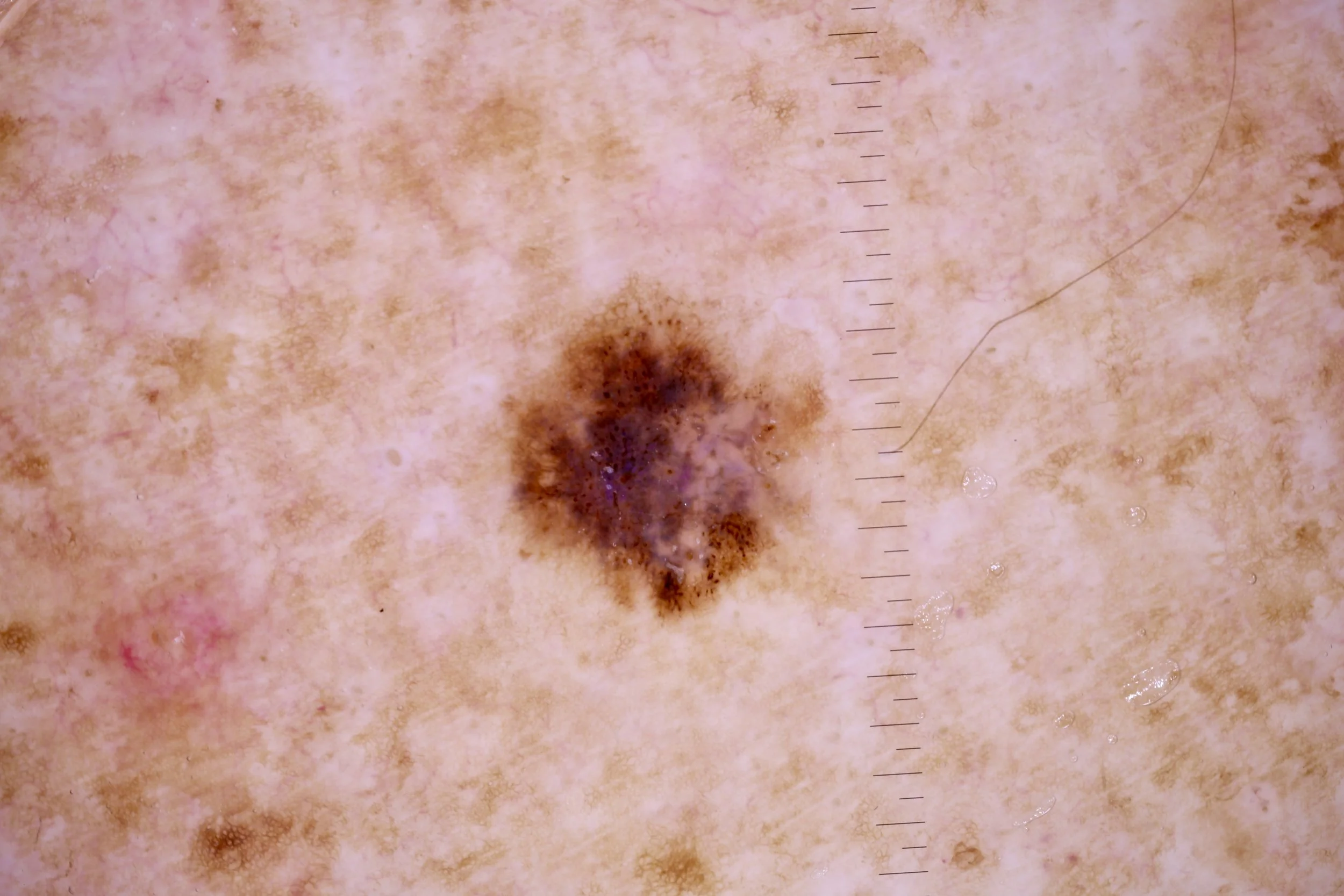 Unsuspected melanoma